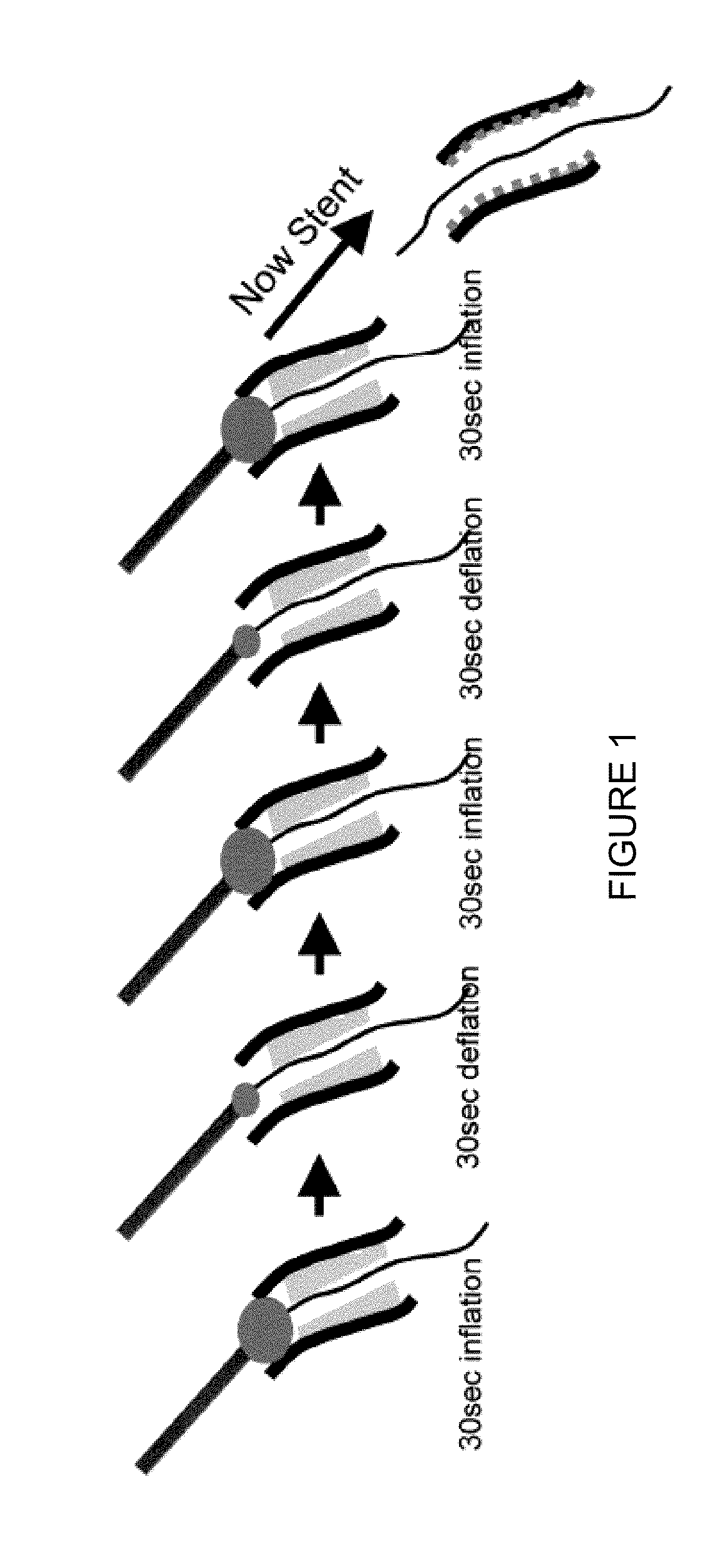 Catheter having inflation and deflation lumen useful for preventing or reducing reperfusion injury