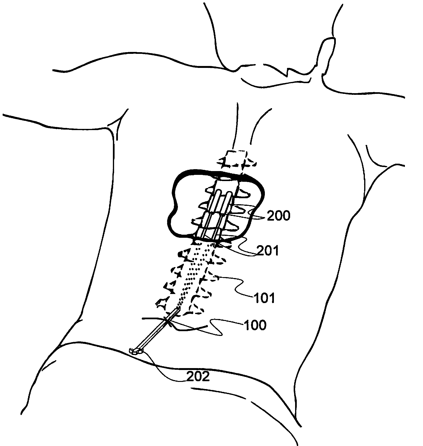 Implantable lead