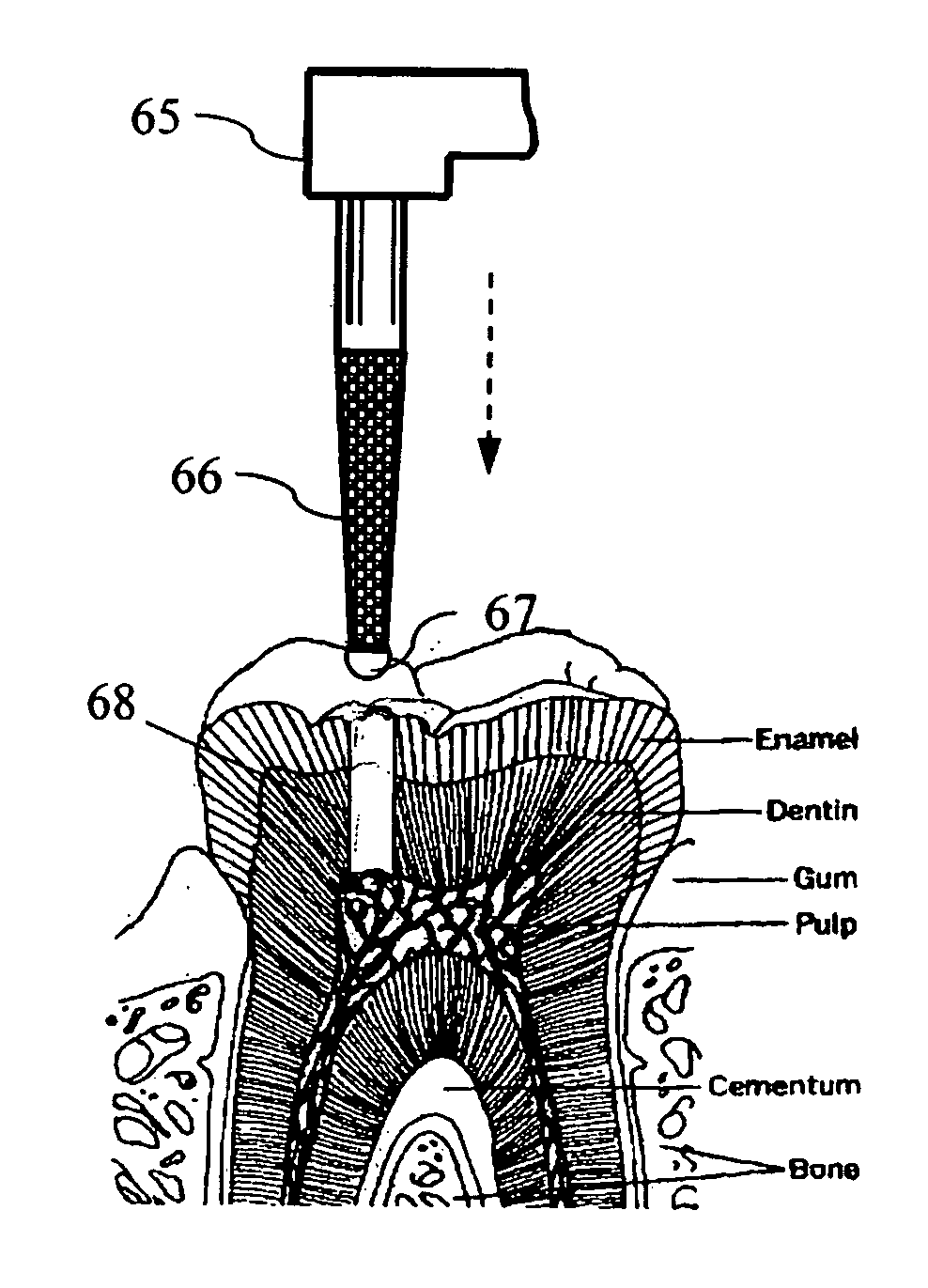 Dental bur with a smooth front