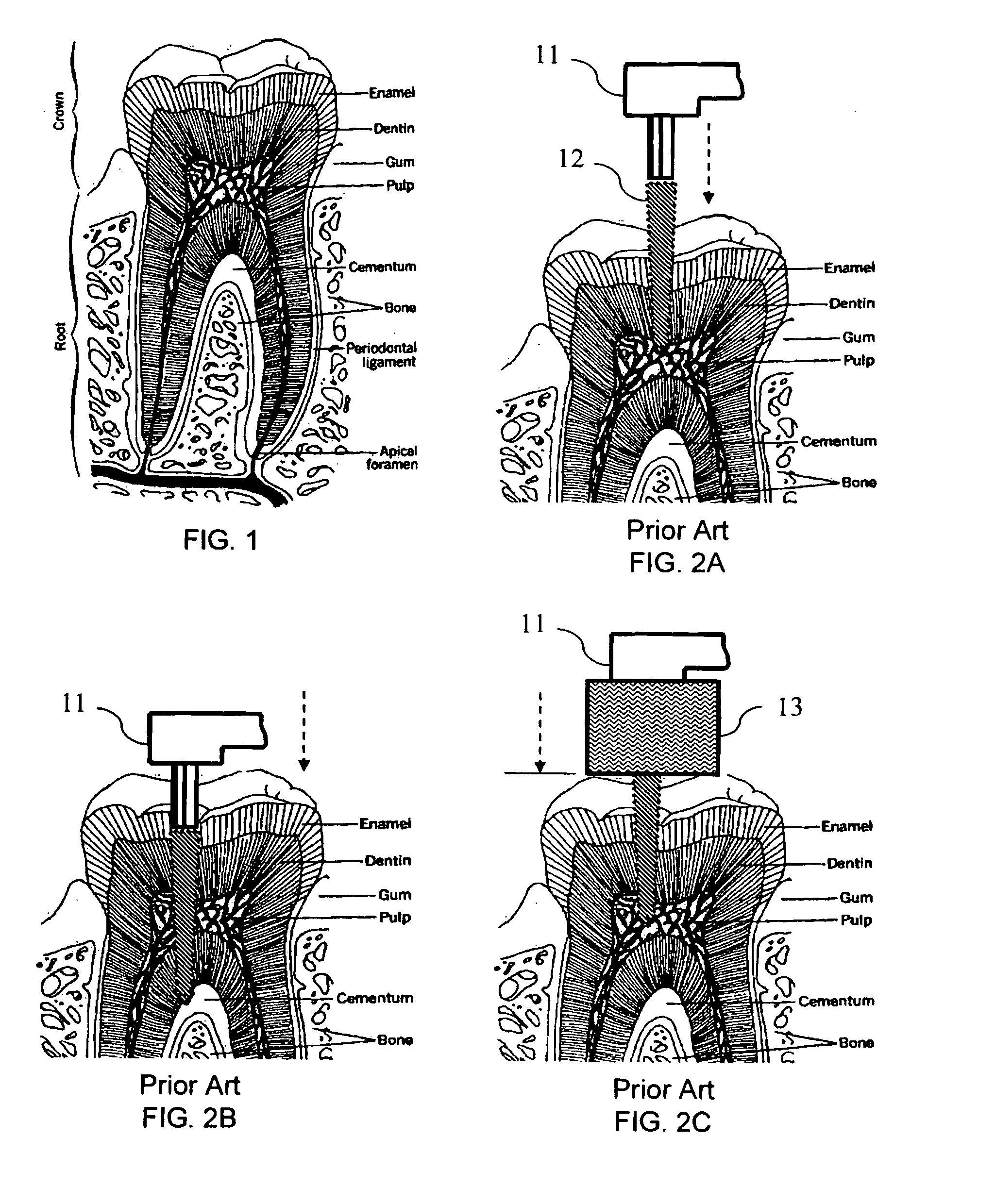 Dental bur with a smooth front