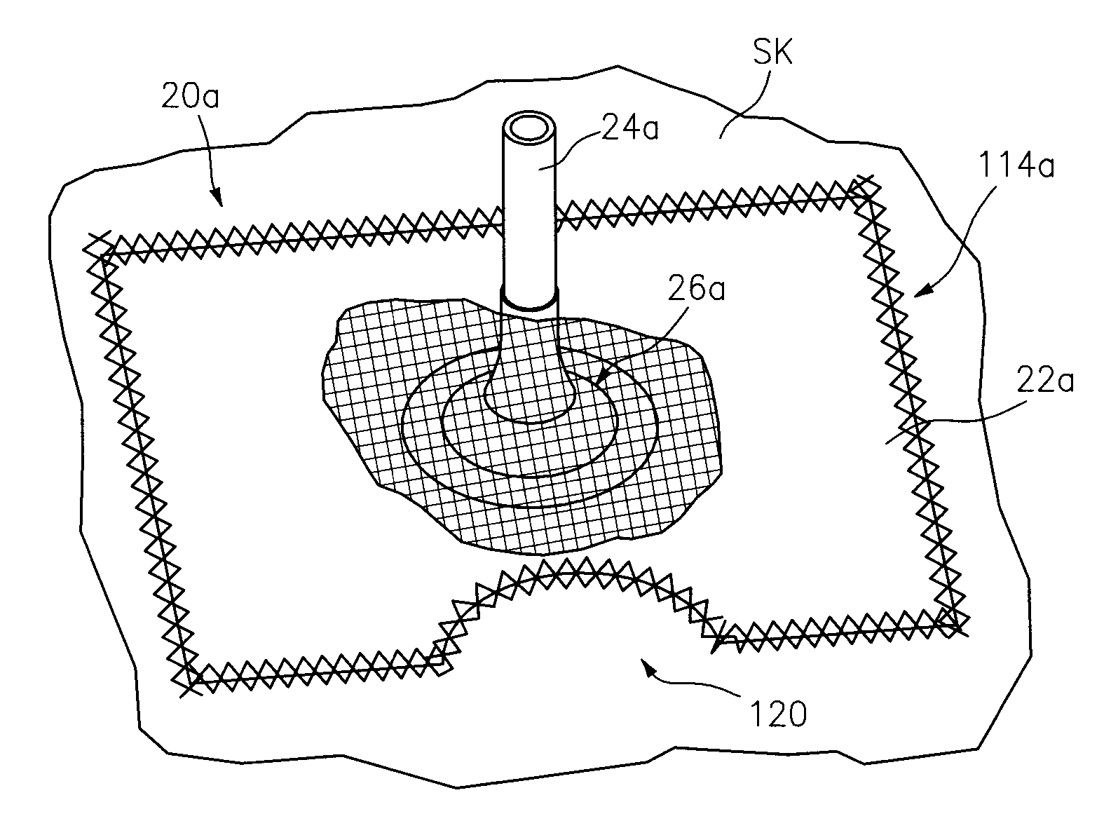 Modifiable occlusive skin dressing