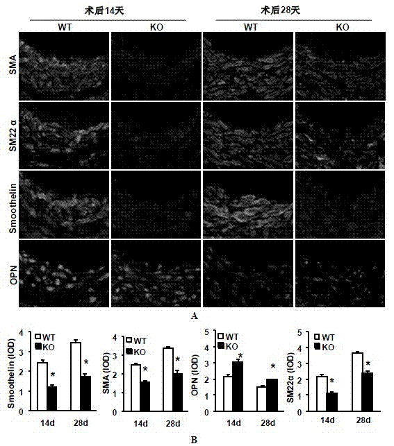 Function and application of interferon regulatory factor 4 (IRF4) in scaffold and endarterectomy restenosis