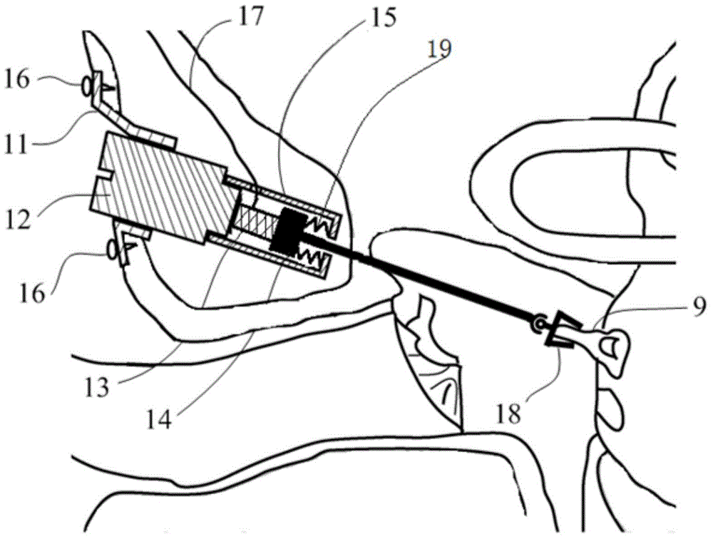 Novel hearing compensation actuator