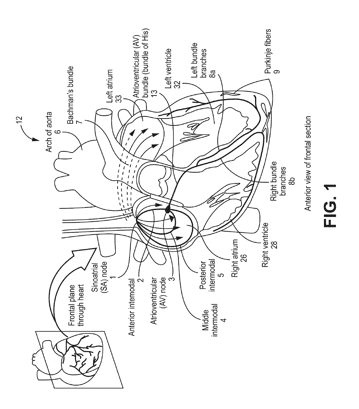 Bundle branch pacing devices and methods