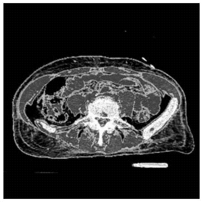 Method for segmenting inhomogeneous medical image