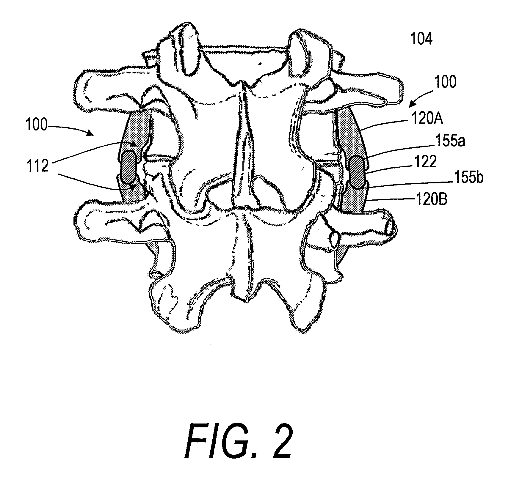 Spine treatment devices and methods