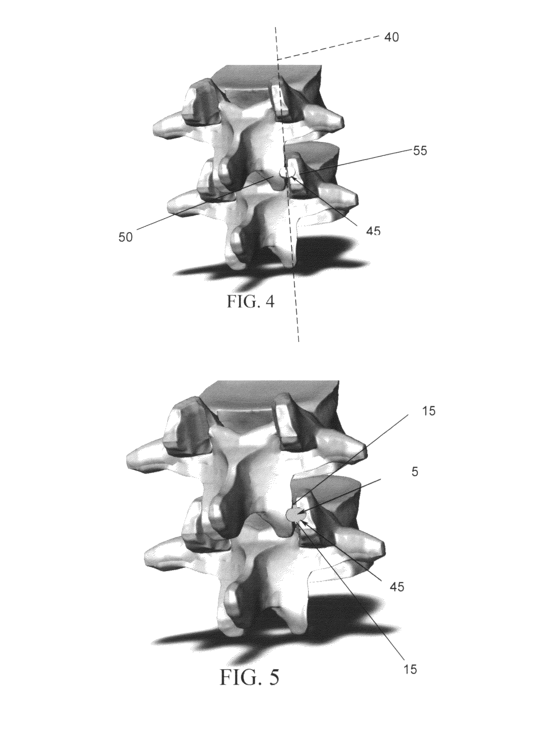 Method and apparatus for spinal facet fusion