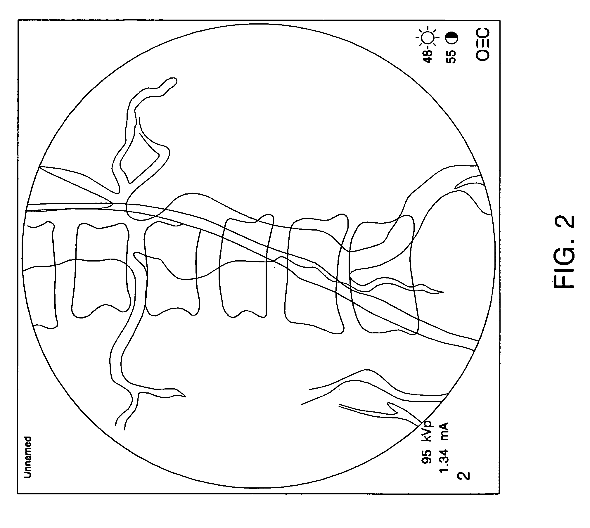 Intraoperative C-ARM fluoroscope datafusion system