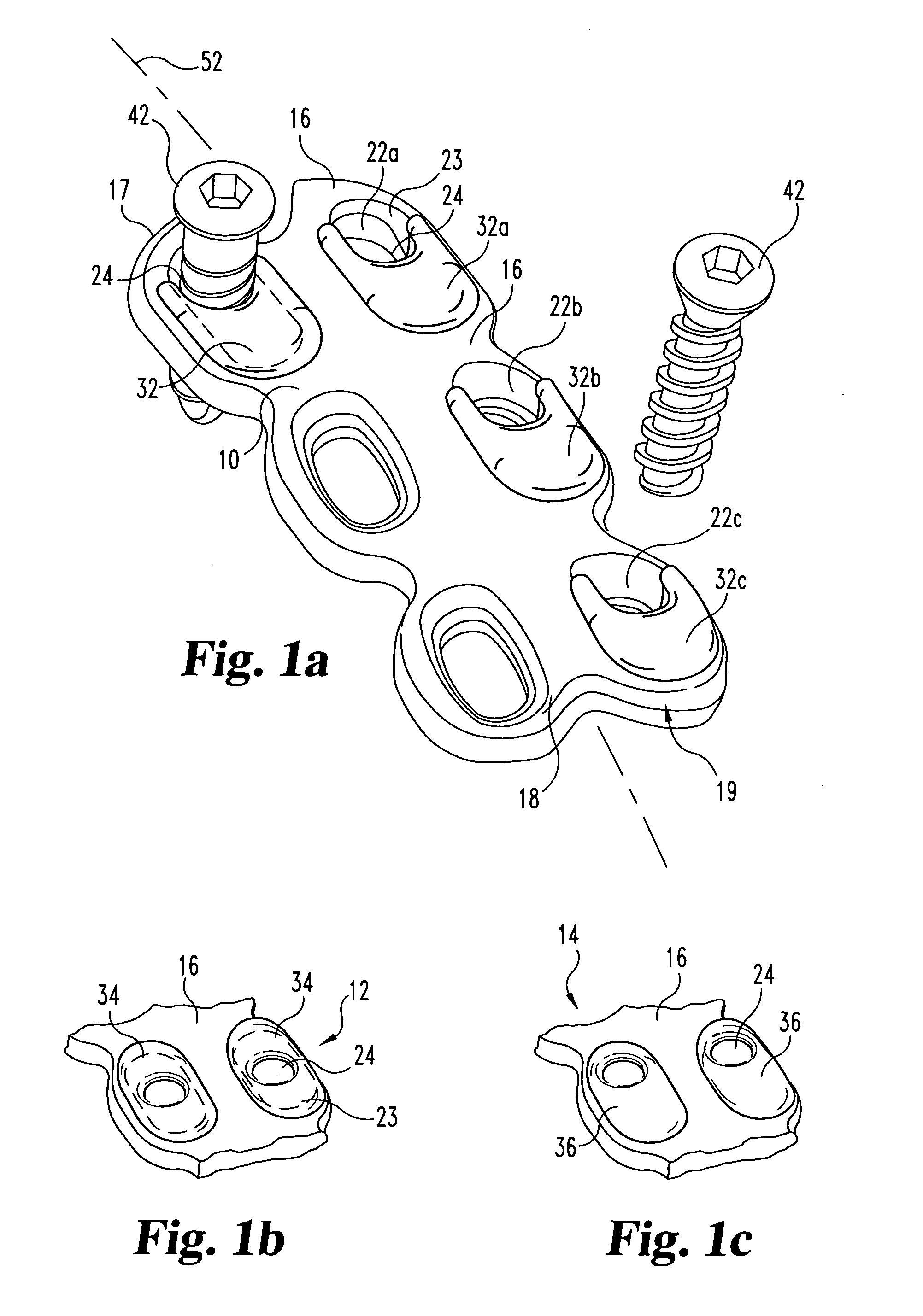 Apparatus and method for providing dynamizable translations to orthopedic implants