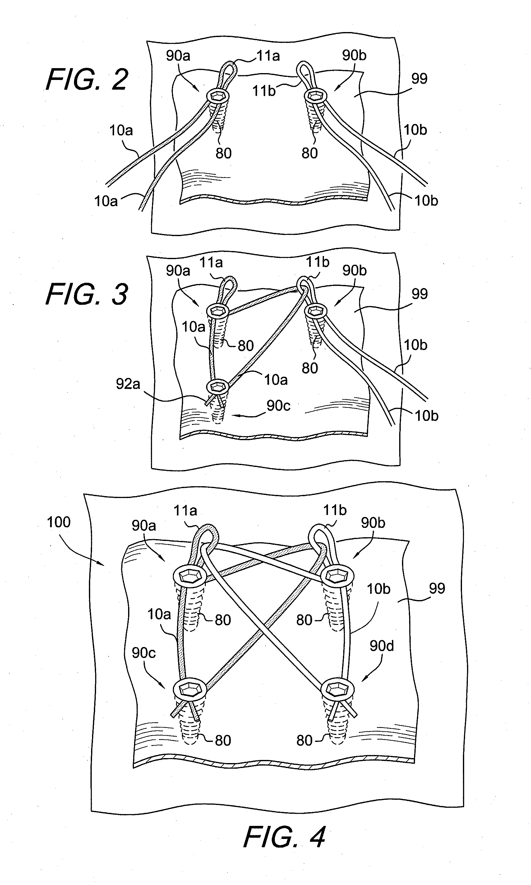 Double row construct with medial row closure