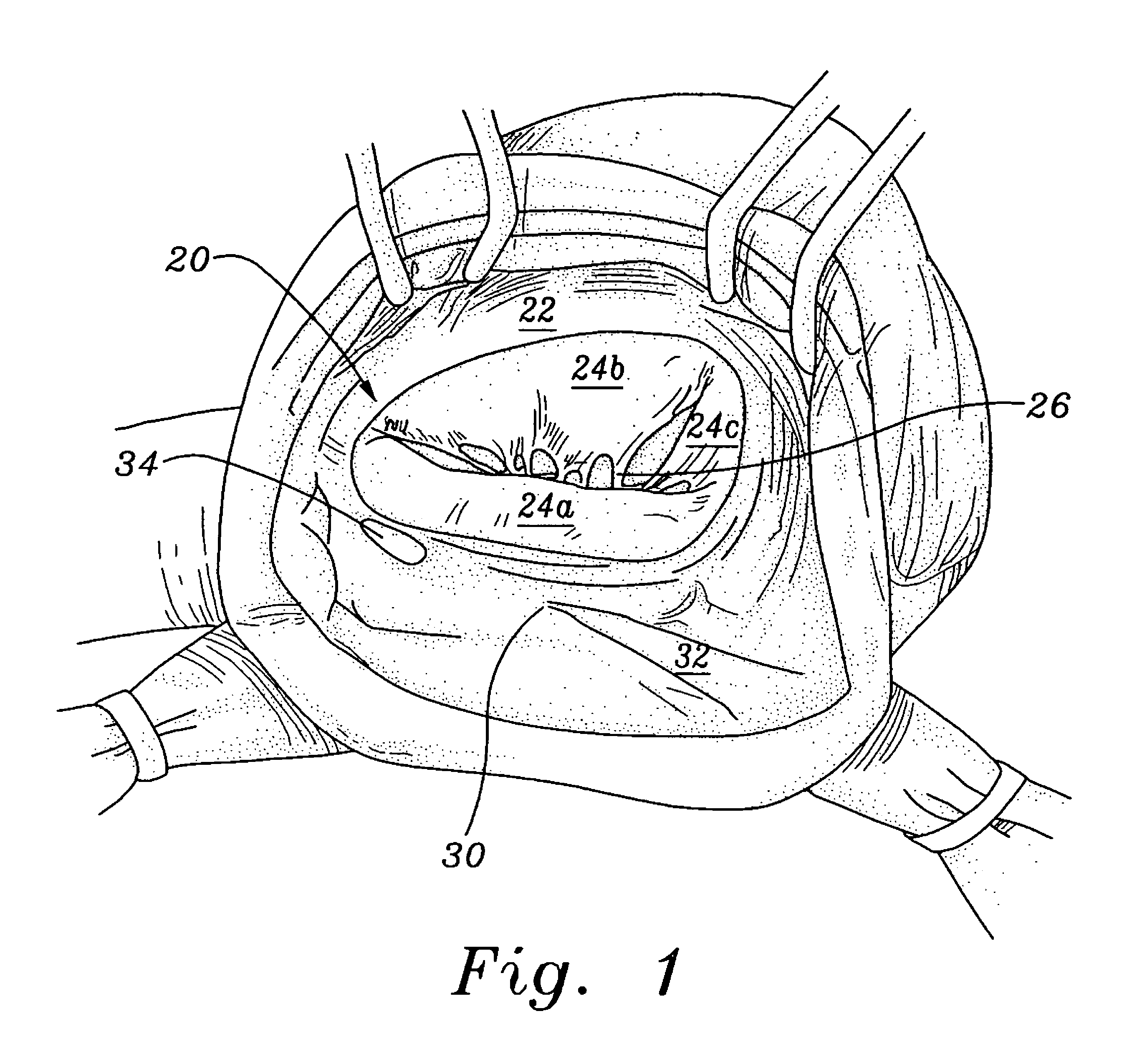 Three-dimensional annuloplasty ring and template