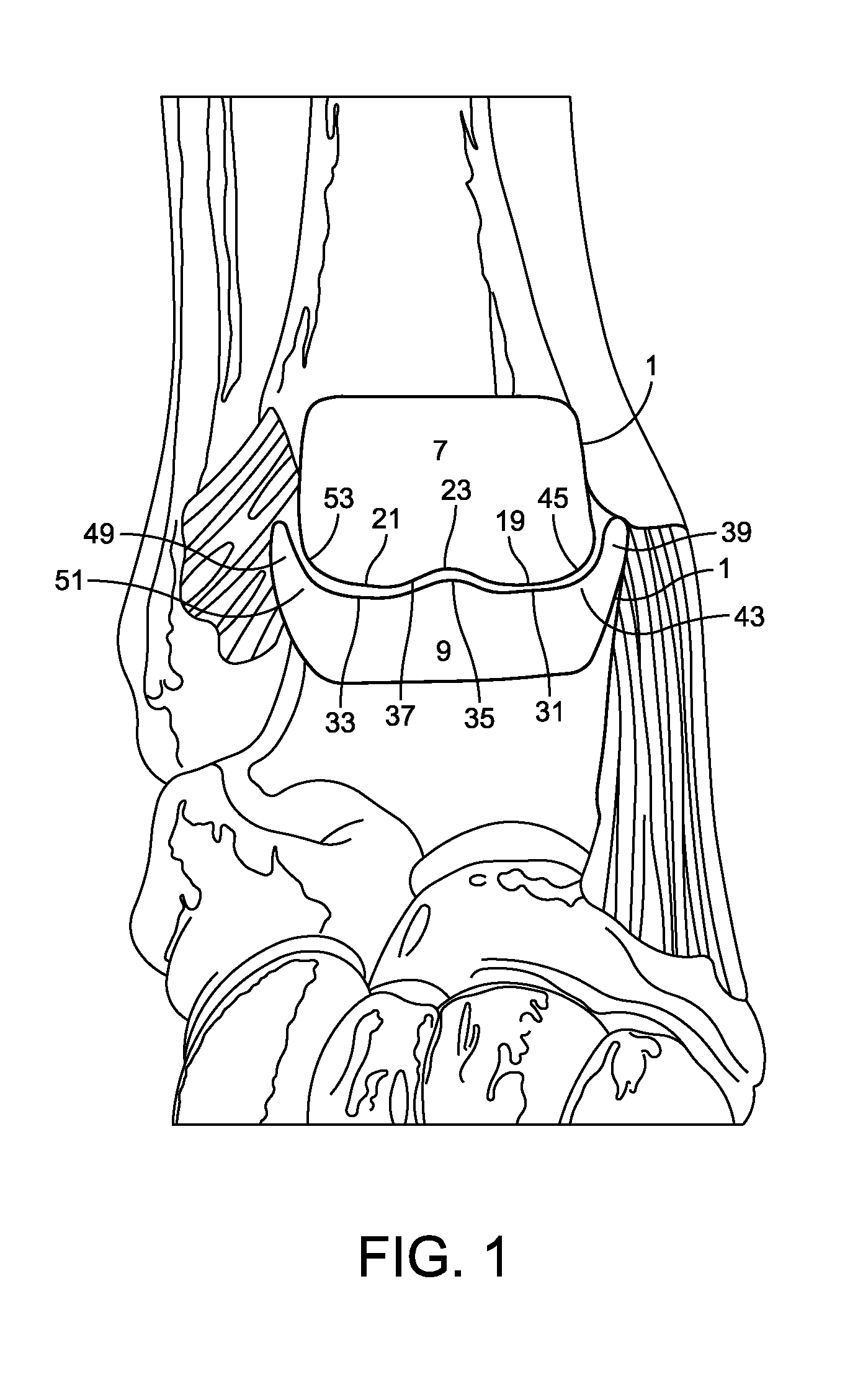 Stabilized total ankle prosthesis