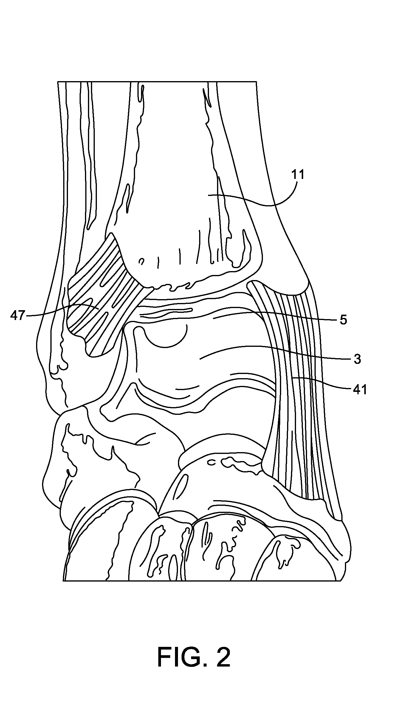 Stabilized total ankle prosthesis