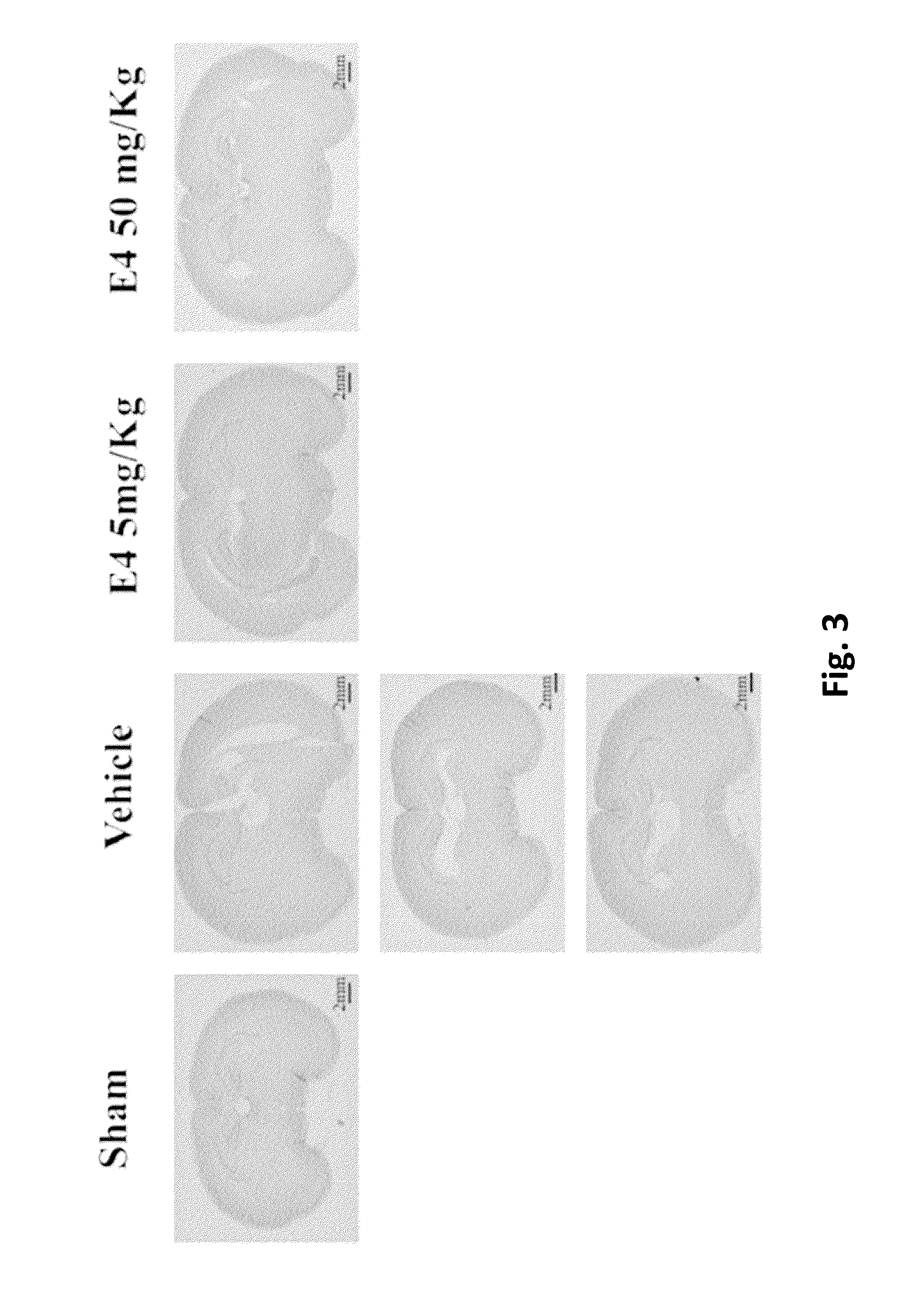 Estrogenic components for use in the treatment of neurological disorders