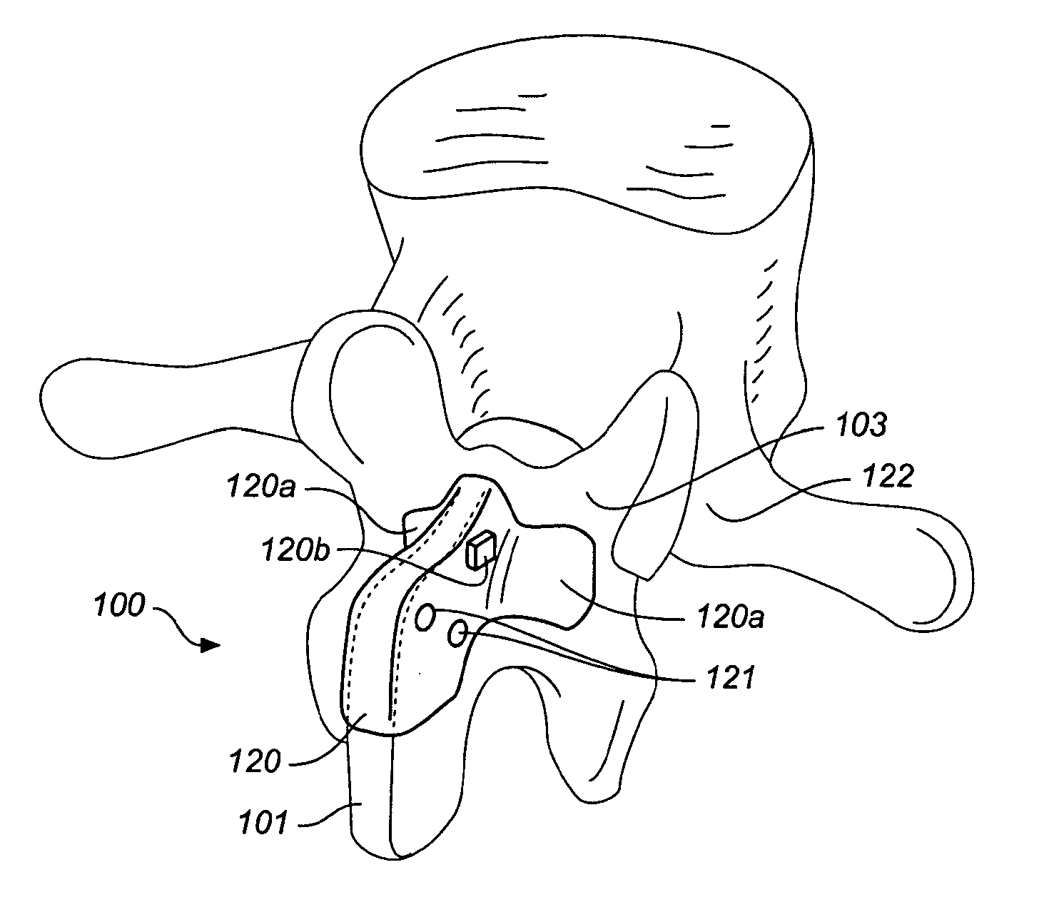 Device and method for correcting a spinal deformity