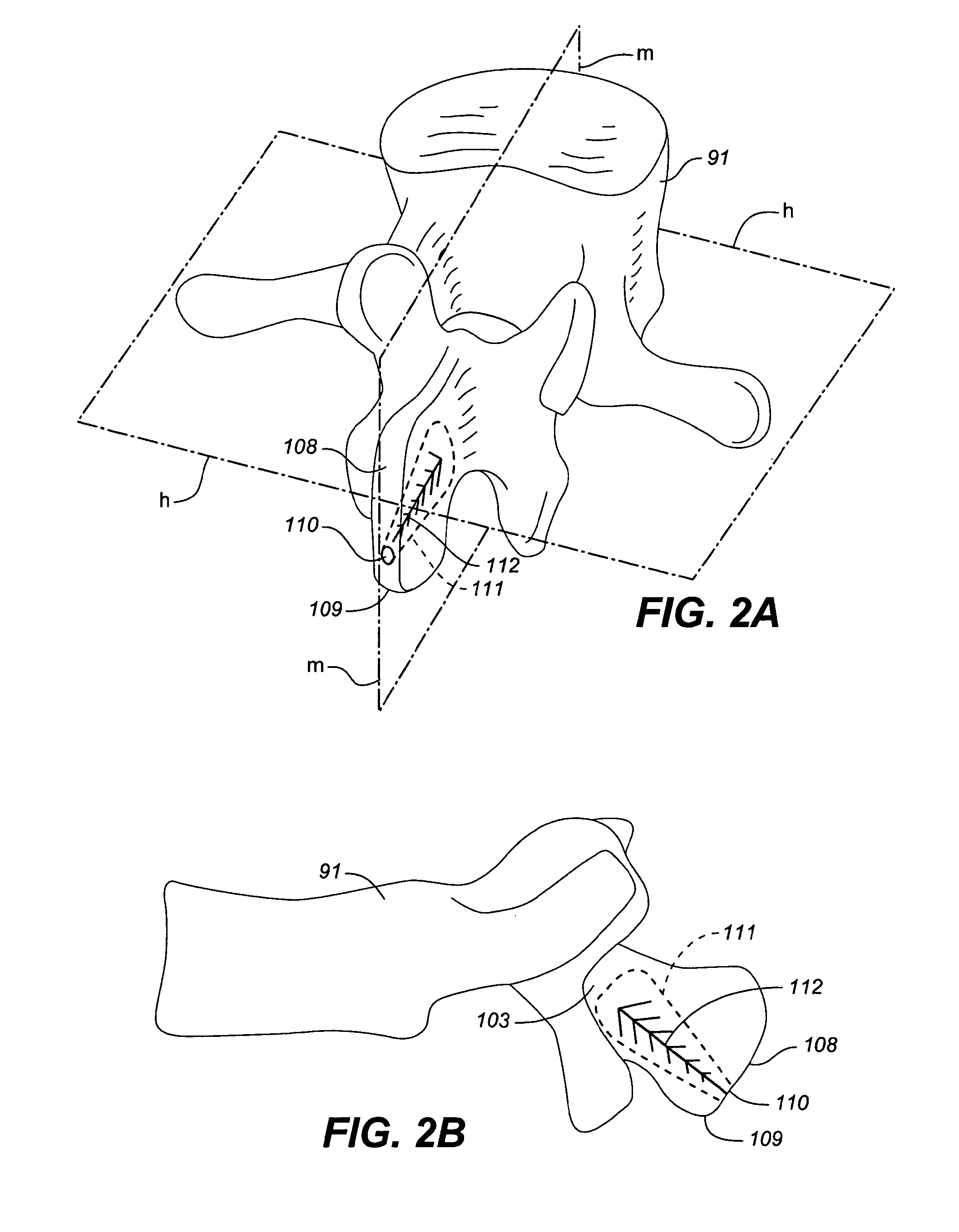 Device and method for correcting a spinal deformity