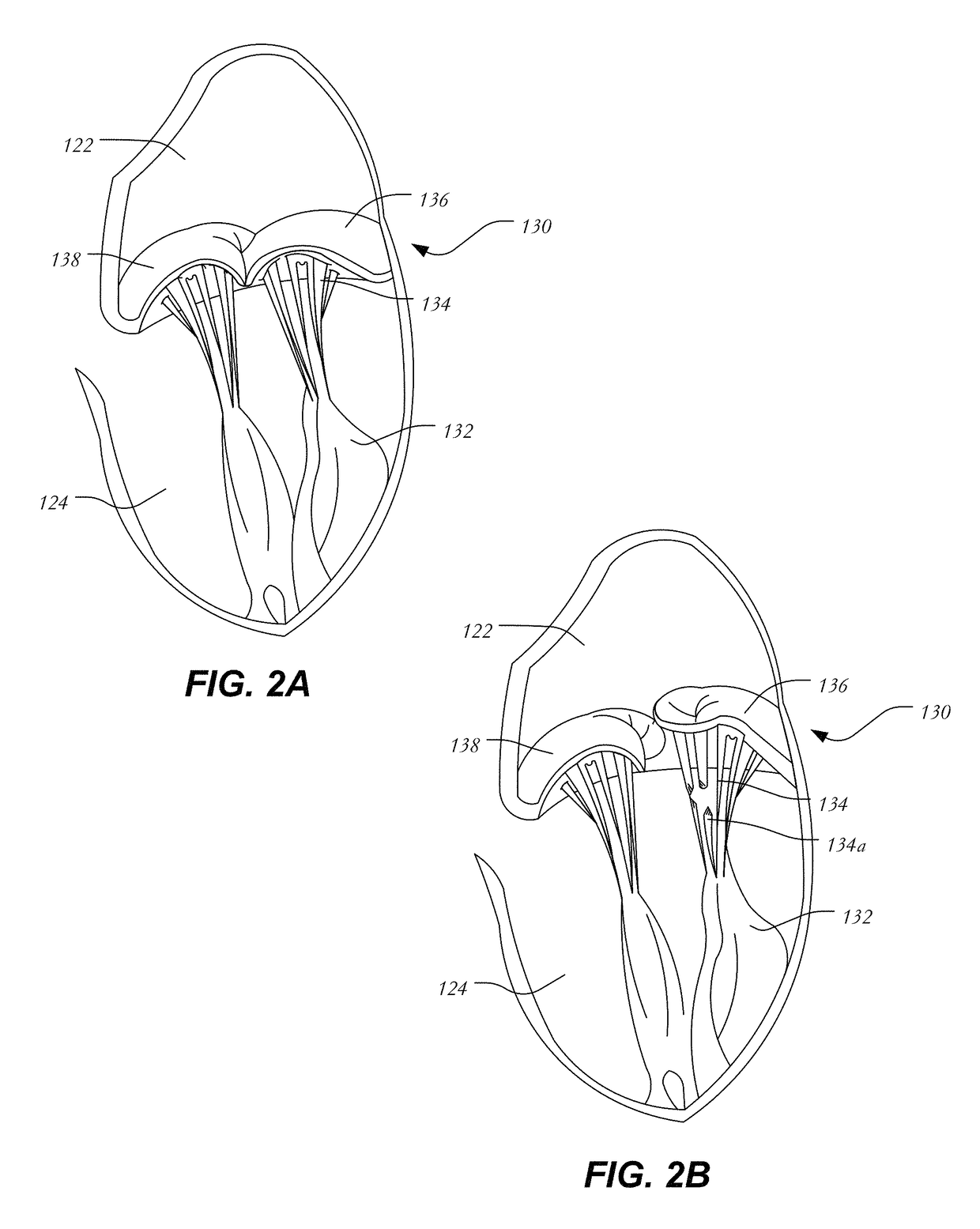 Mitral heart valve replacement