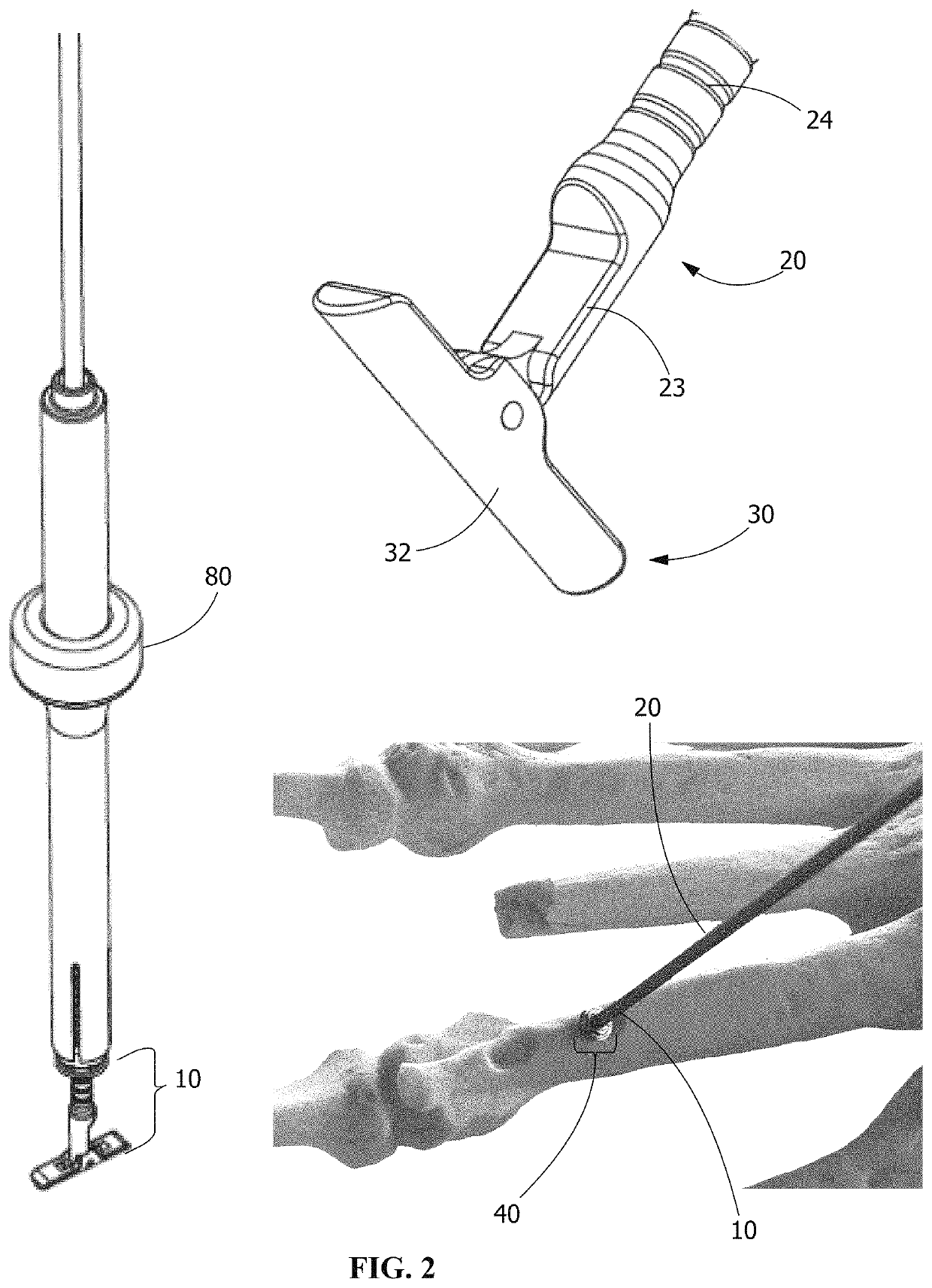 Compression fixation system