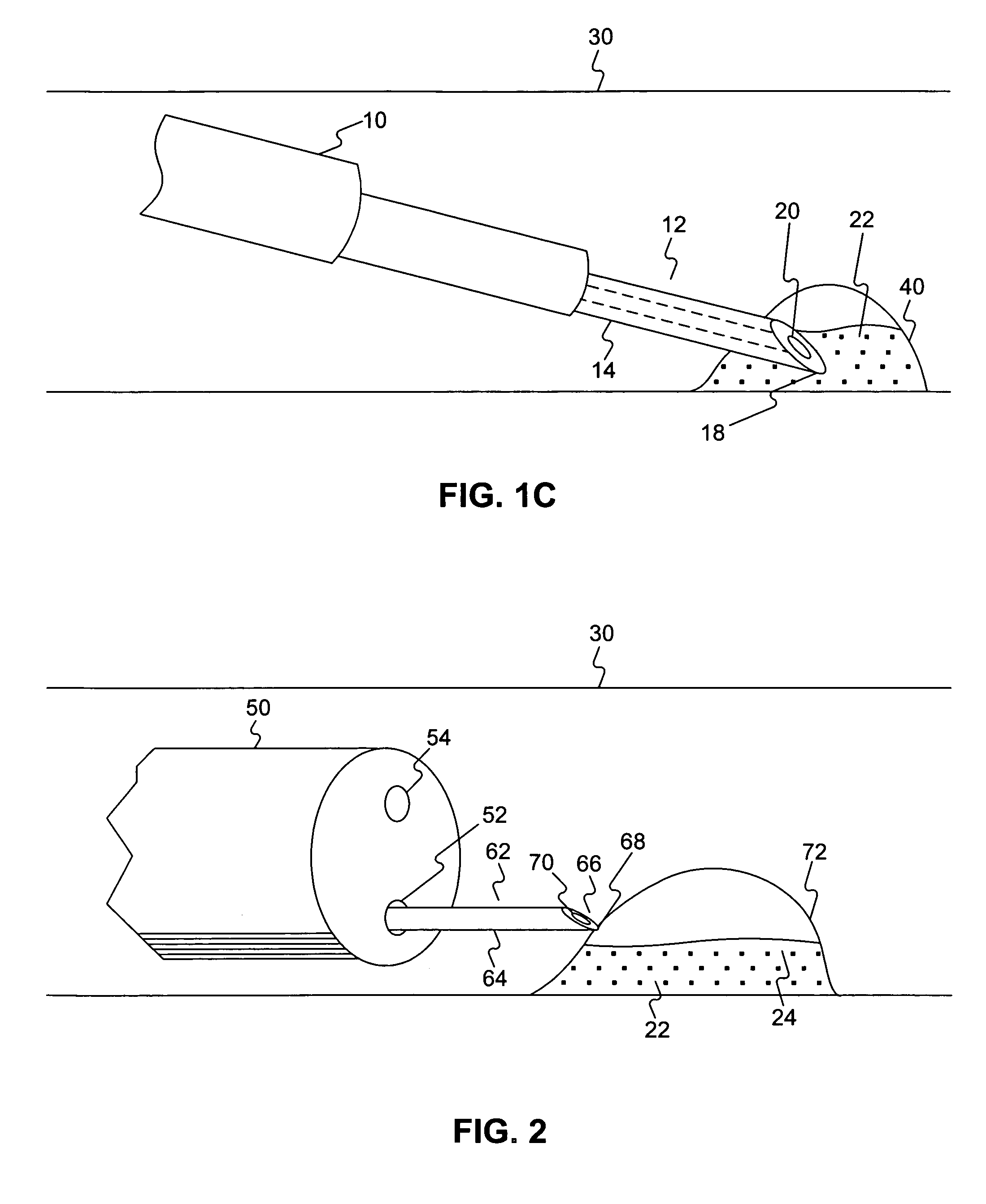 Endoscopic resection method