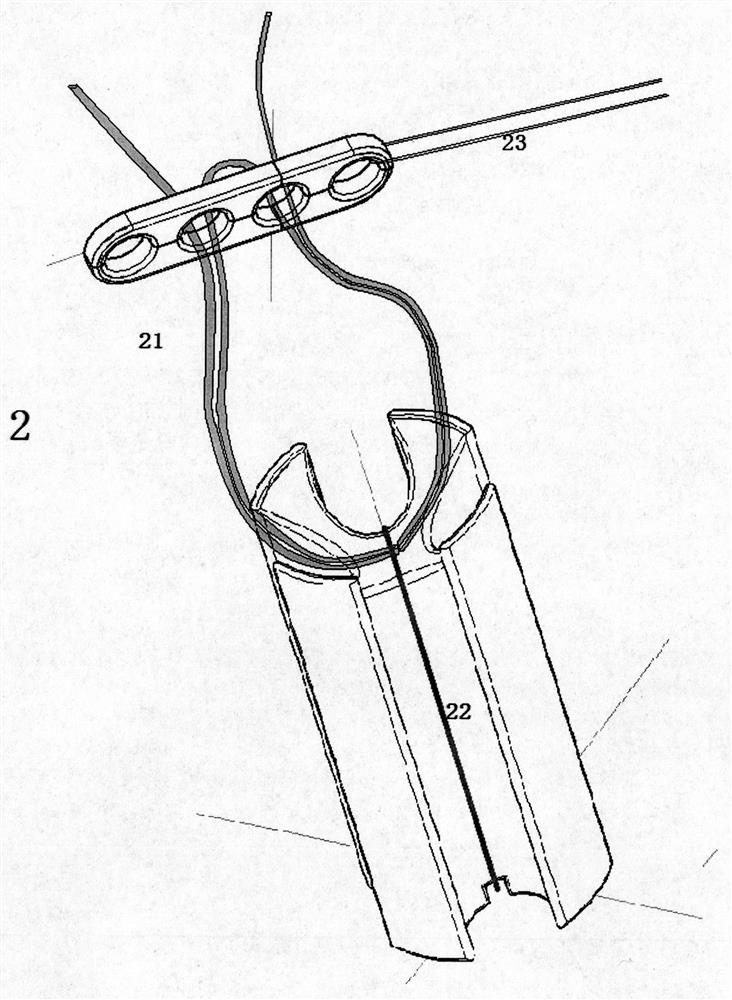 Ligament Fixation System Containing Suspension Plates and Absorbable Implants