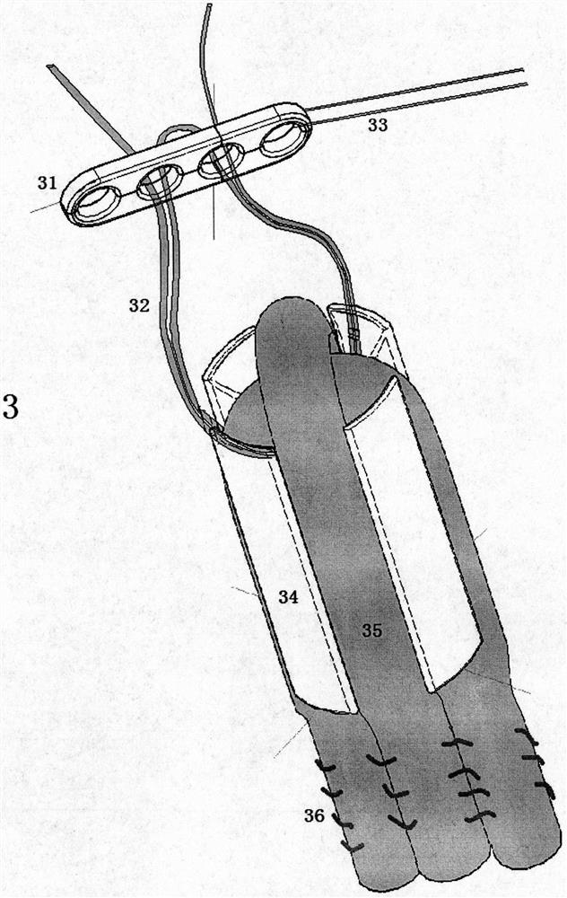 Ligament Fixation System Containing Suspension Plates and Absorbable Implants