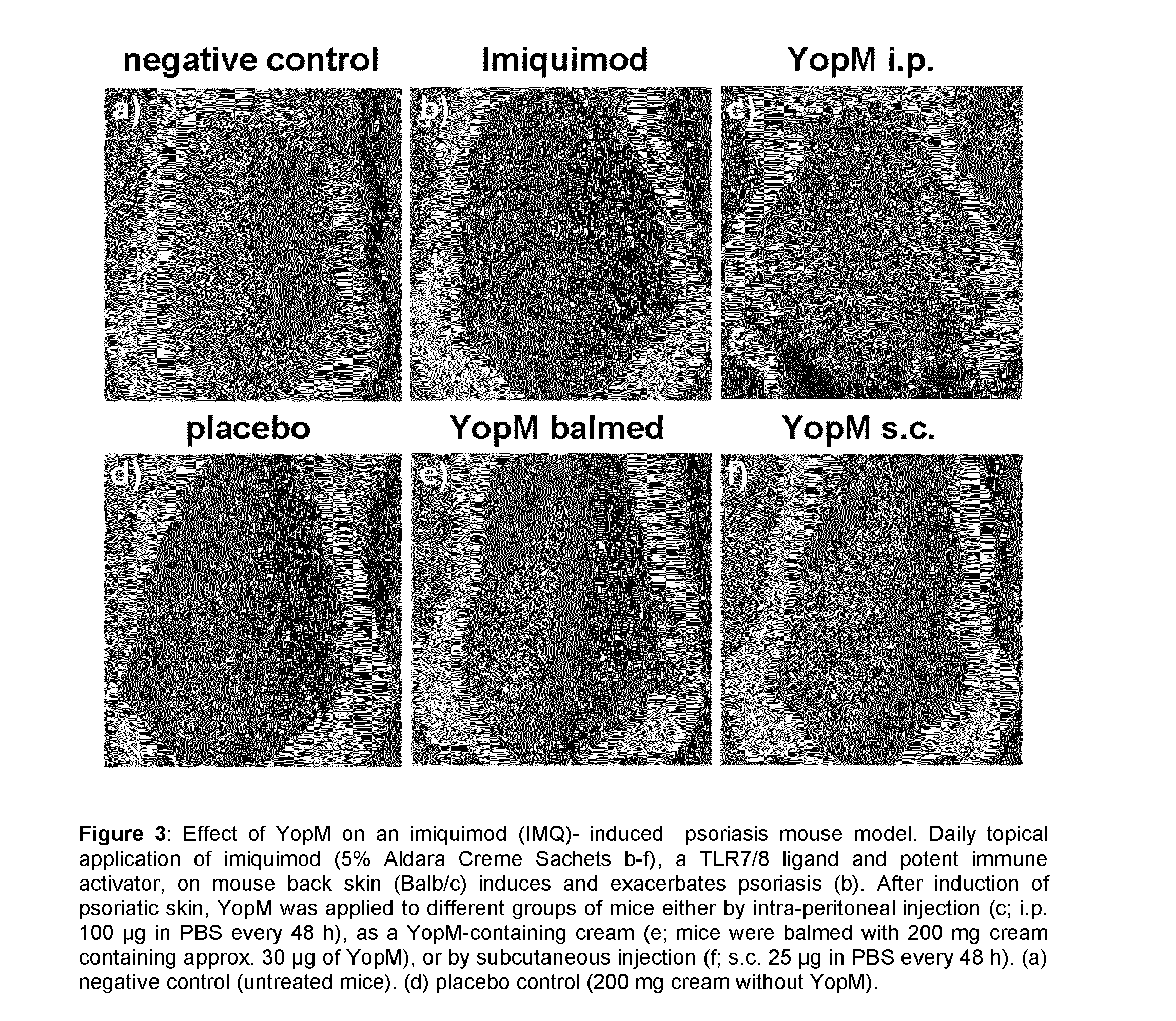 Yersinia outer protein m (YOPM) in the treatment of psoriasis