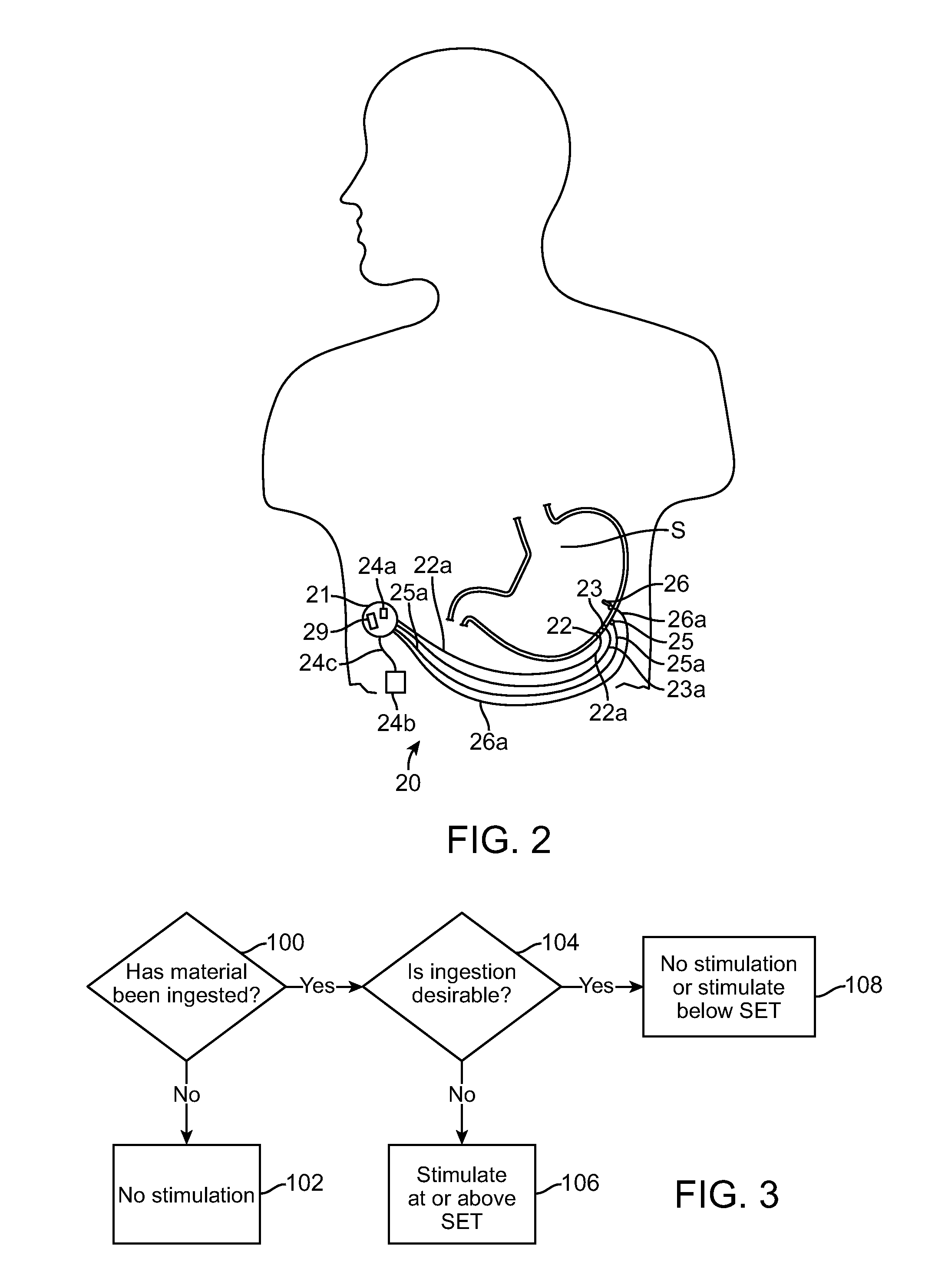 Sensor Driven Gastric Stimulation for Patient Management