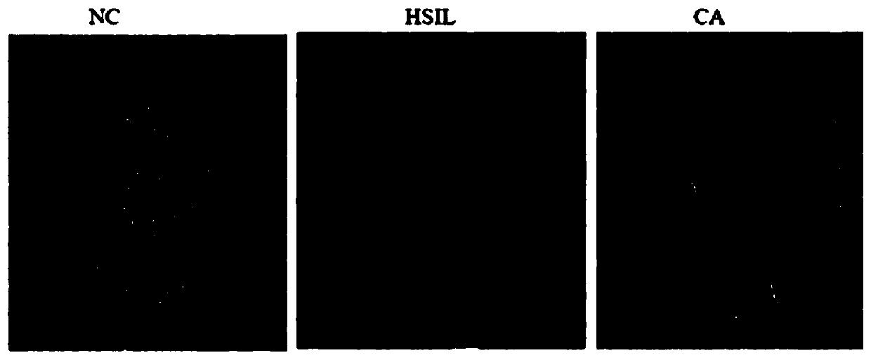 Cervical cancer staging method based on cervical exfoliated cell gene detection, and detection kit