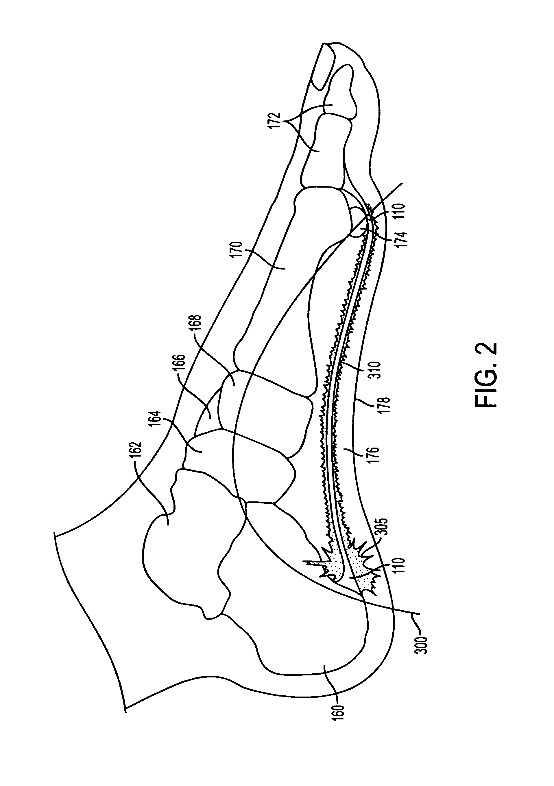 System for treatment of plantar fasciitis