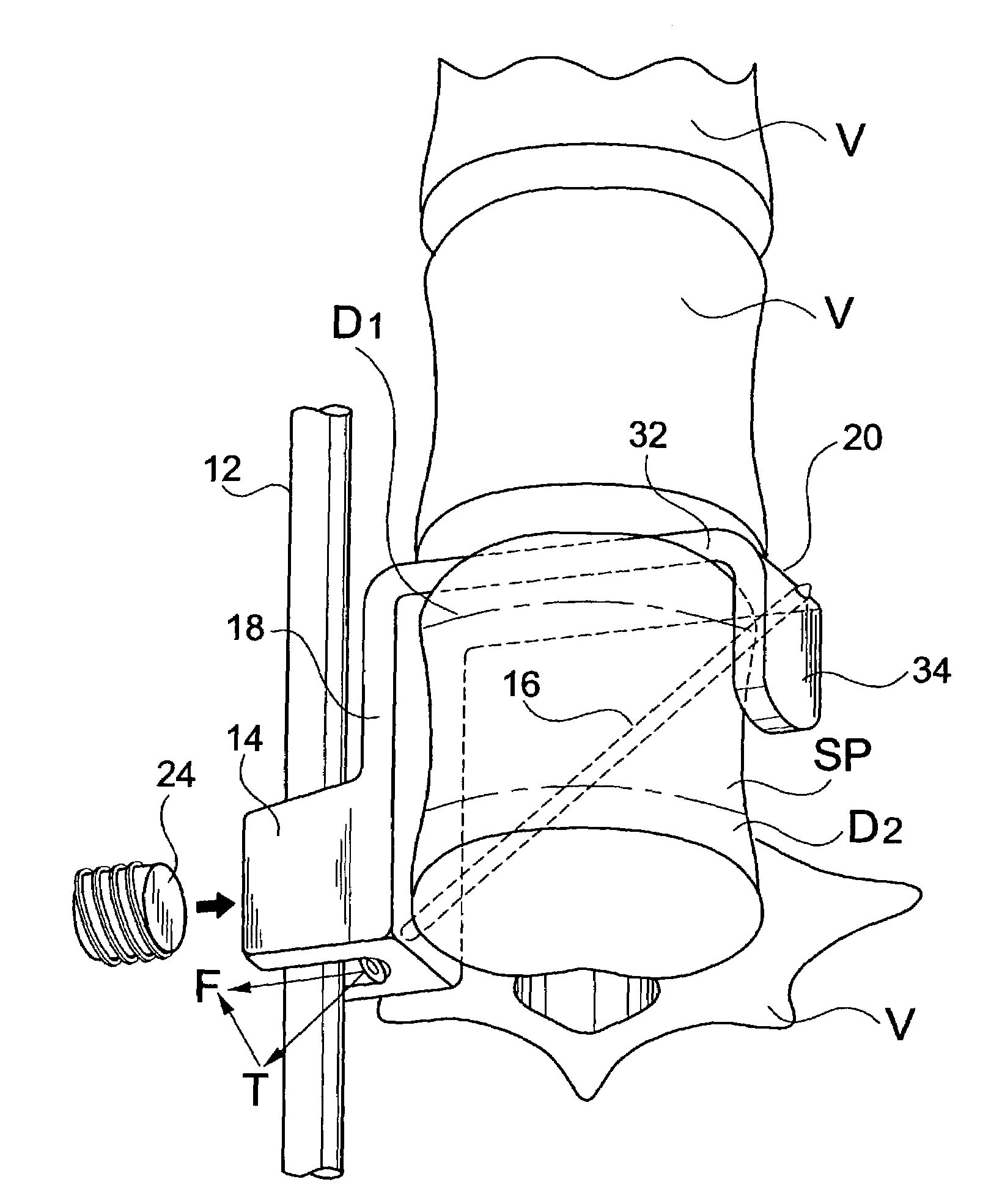 Connector for attaching an alignment rod to a bone structure