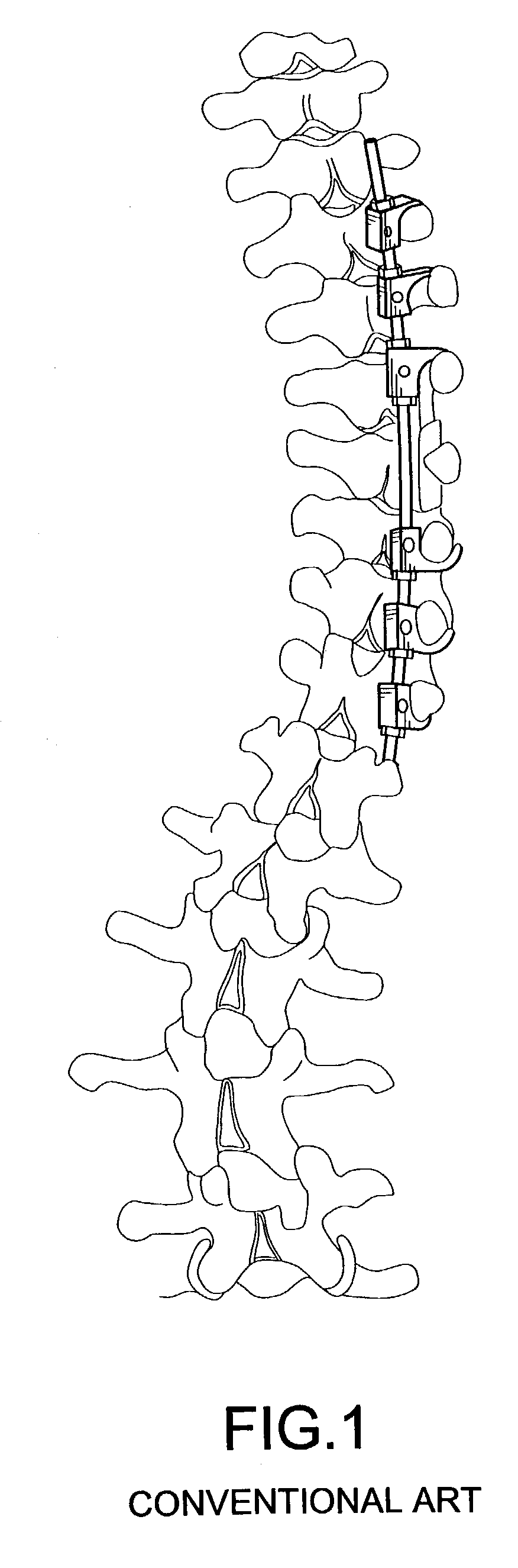 Connector for attaching an alignment rod to a bone structure