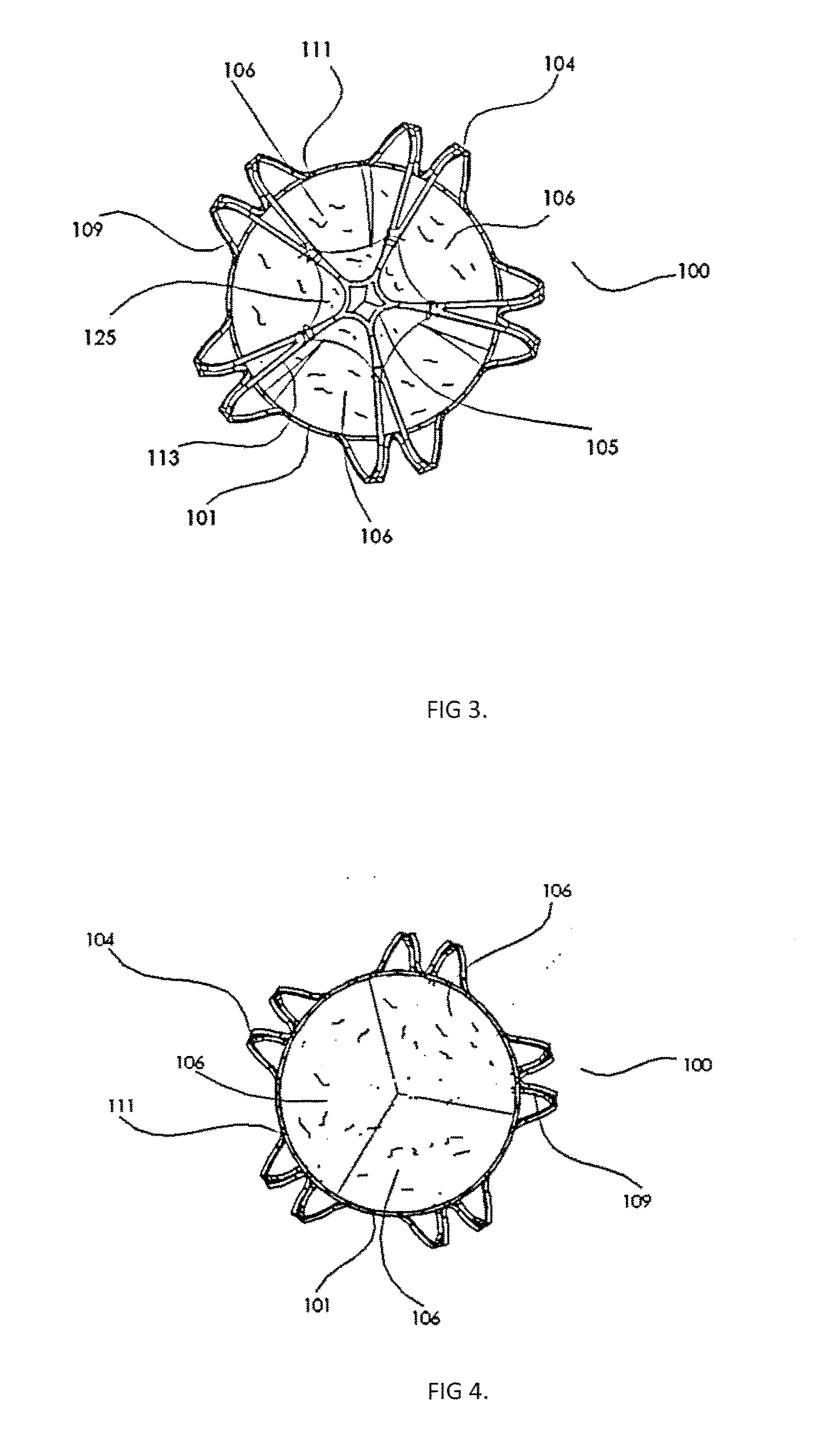 Transcatheter Pulmonary Ball Valve Assembly