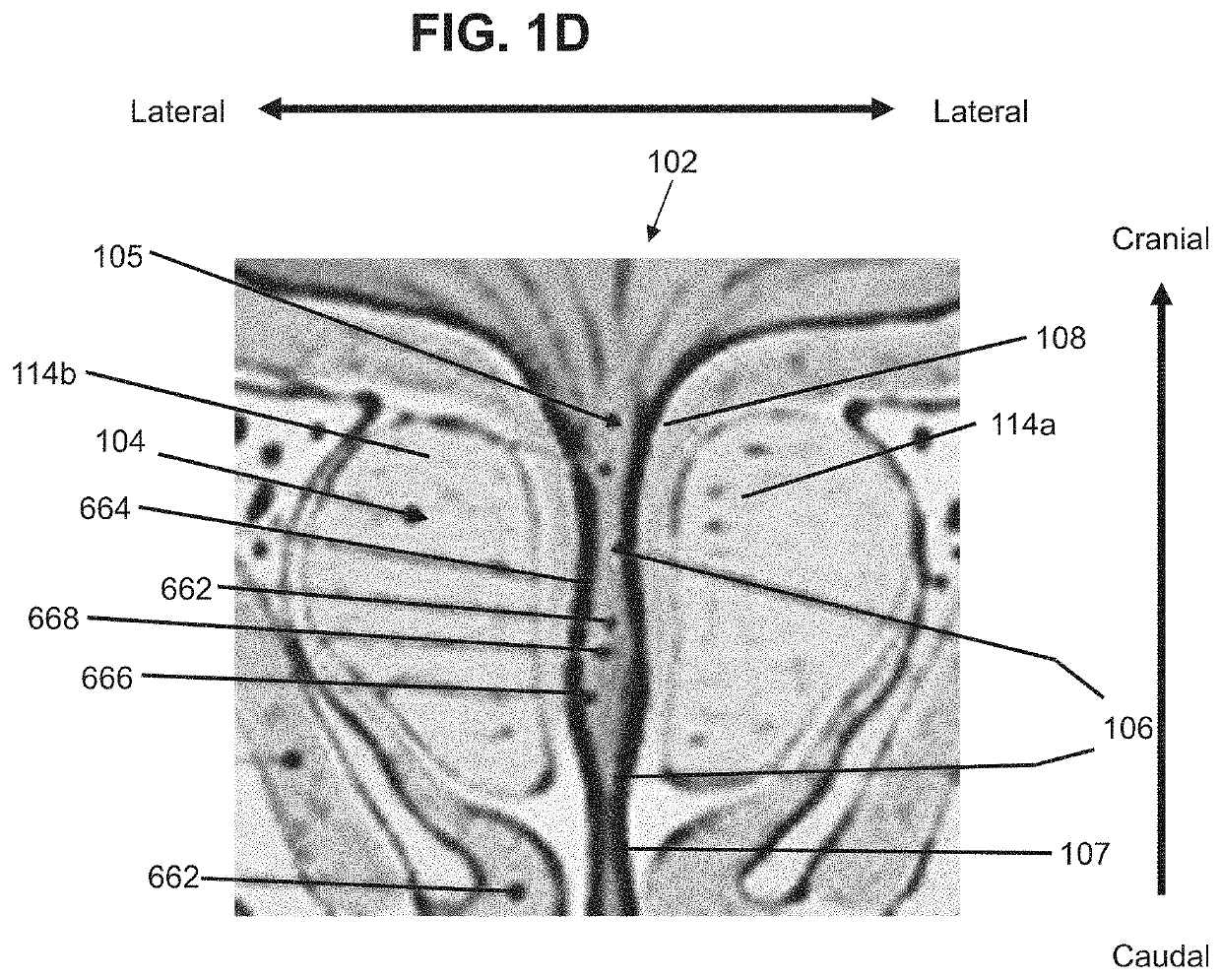 Dilating device and method for prostatic urethra