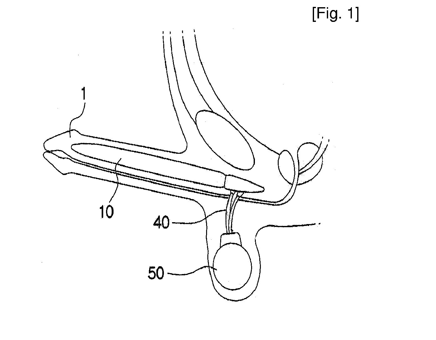 Inflatable Prosthesis For Aiding Penile Erection And Augmentation