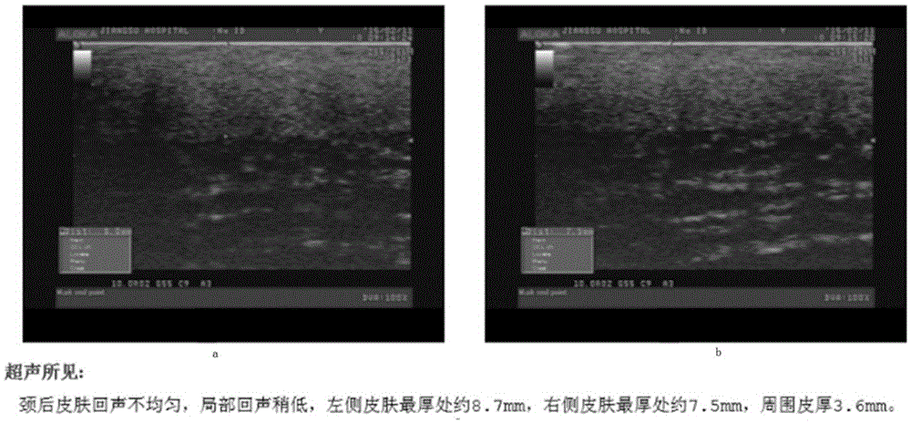 Application of tranilast in preparation of drug for treating pyoderma gangrenosum