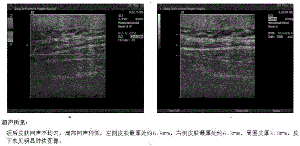 Application of tranilast in preparation of drug for treating pyoderma gangrenosum