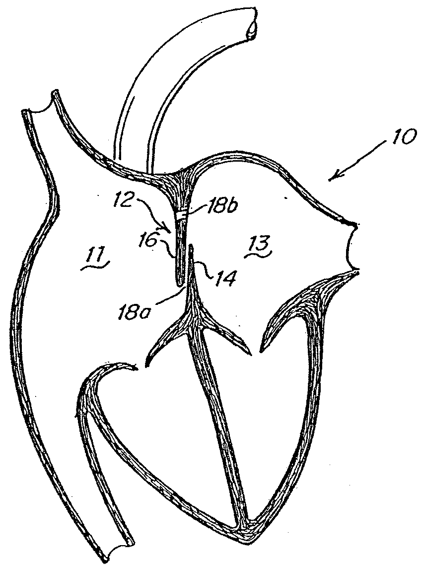 Patent foramen ovale (PFO) closure device with linearly elongating petals