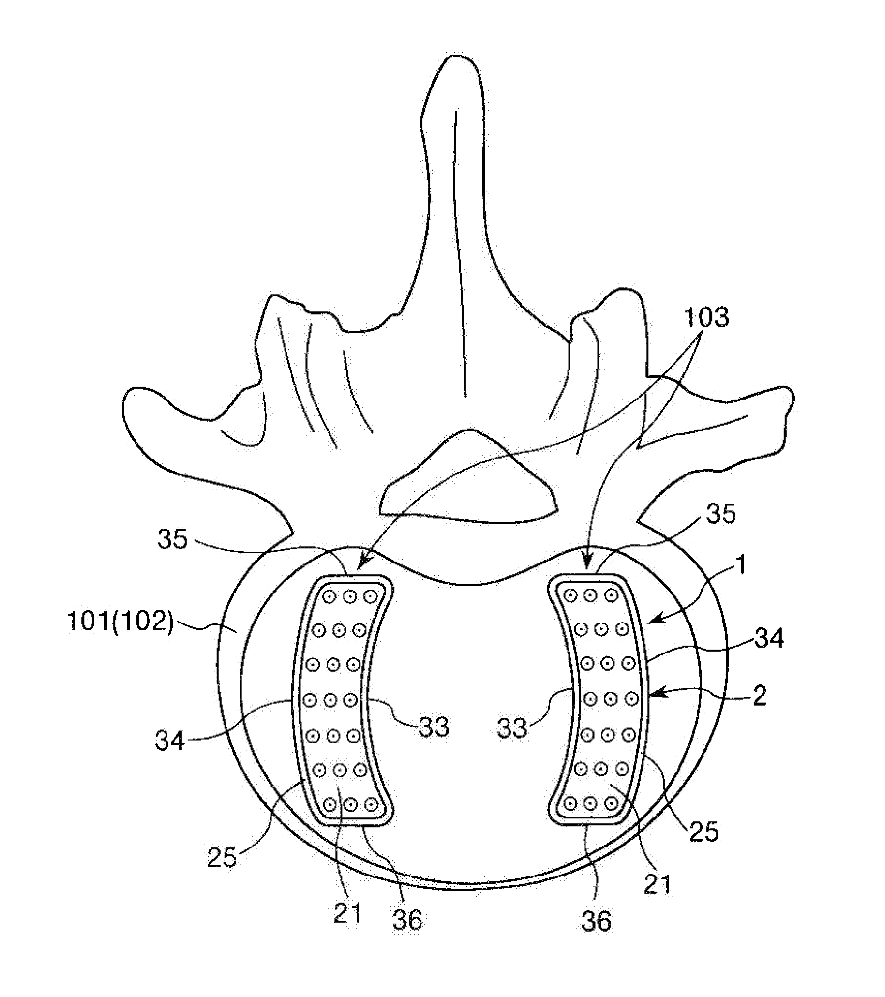 Vertebral body spacer