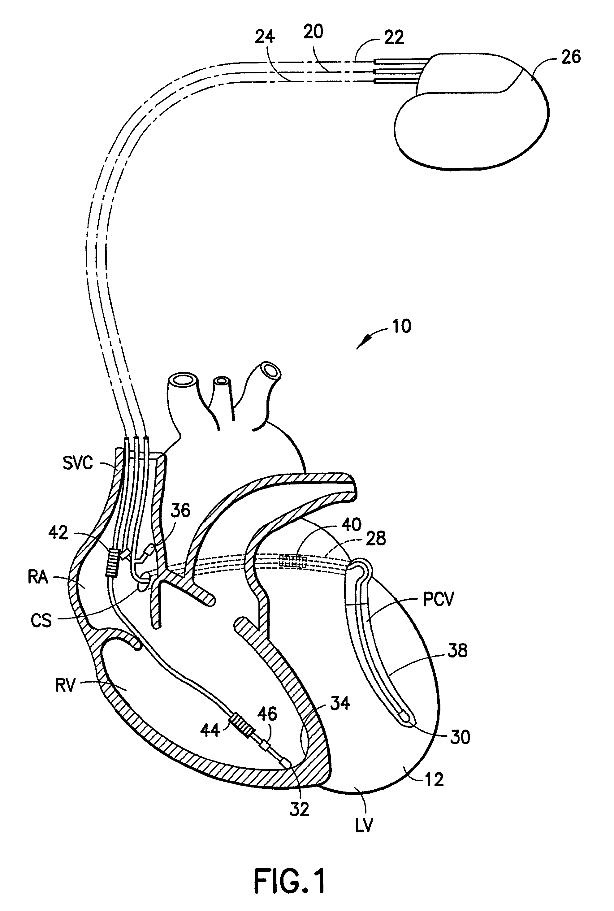 Leads using composite materials for conductors and stylet insertion for improved handling characteristics in lead implantation performance