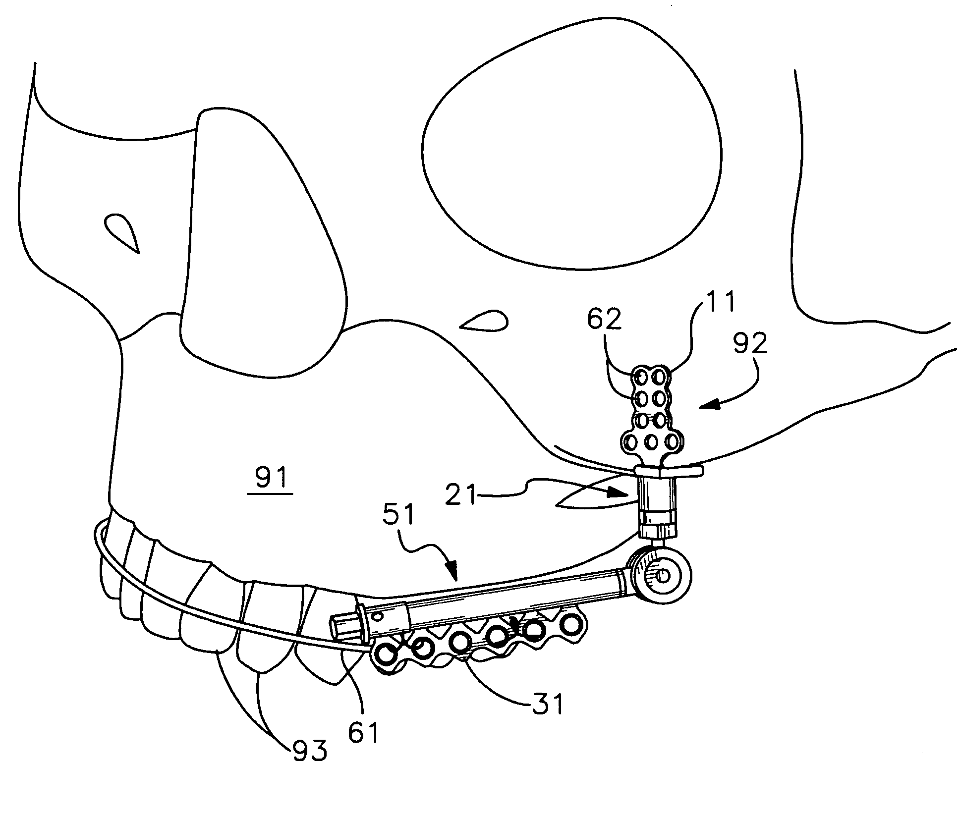 Angularly adjustable maxillary distractor and method of distraction