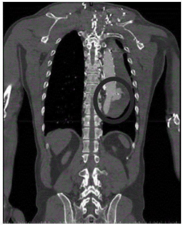 Method for forming aortic stent graft