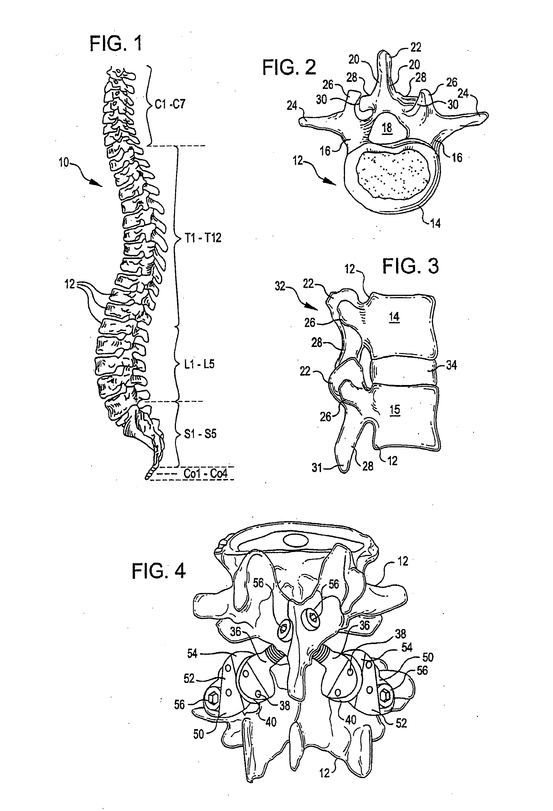 Crossbar spinal prosthesis having a modular design and systems for treating spinal pathologies