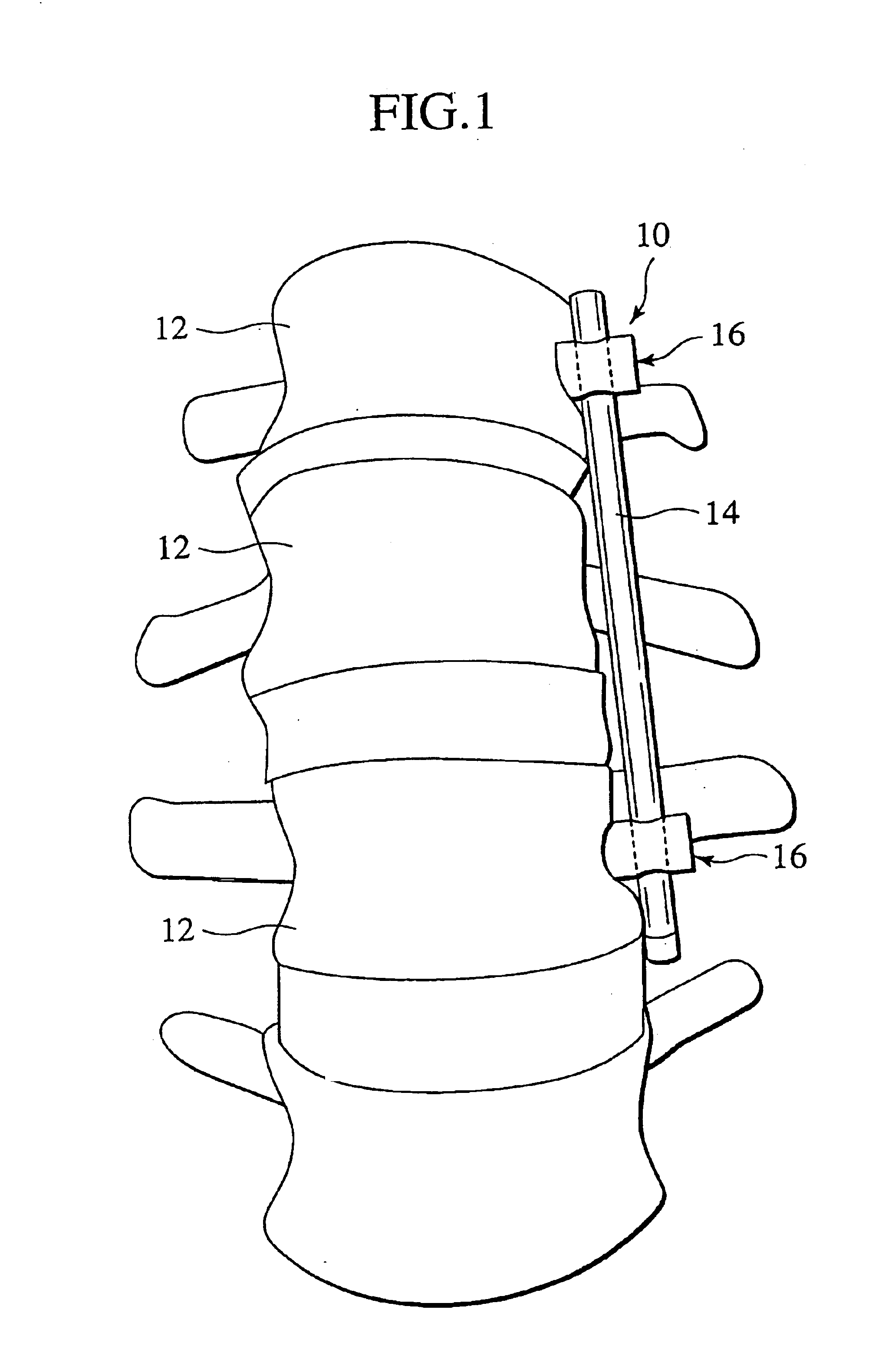 Spinal implant, driver tool and nut guide