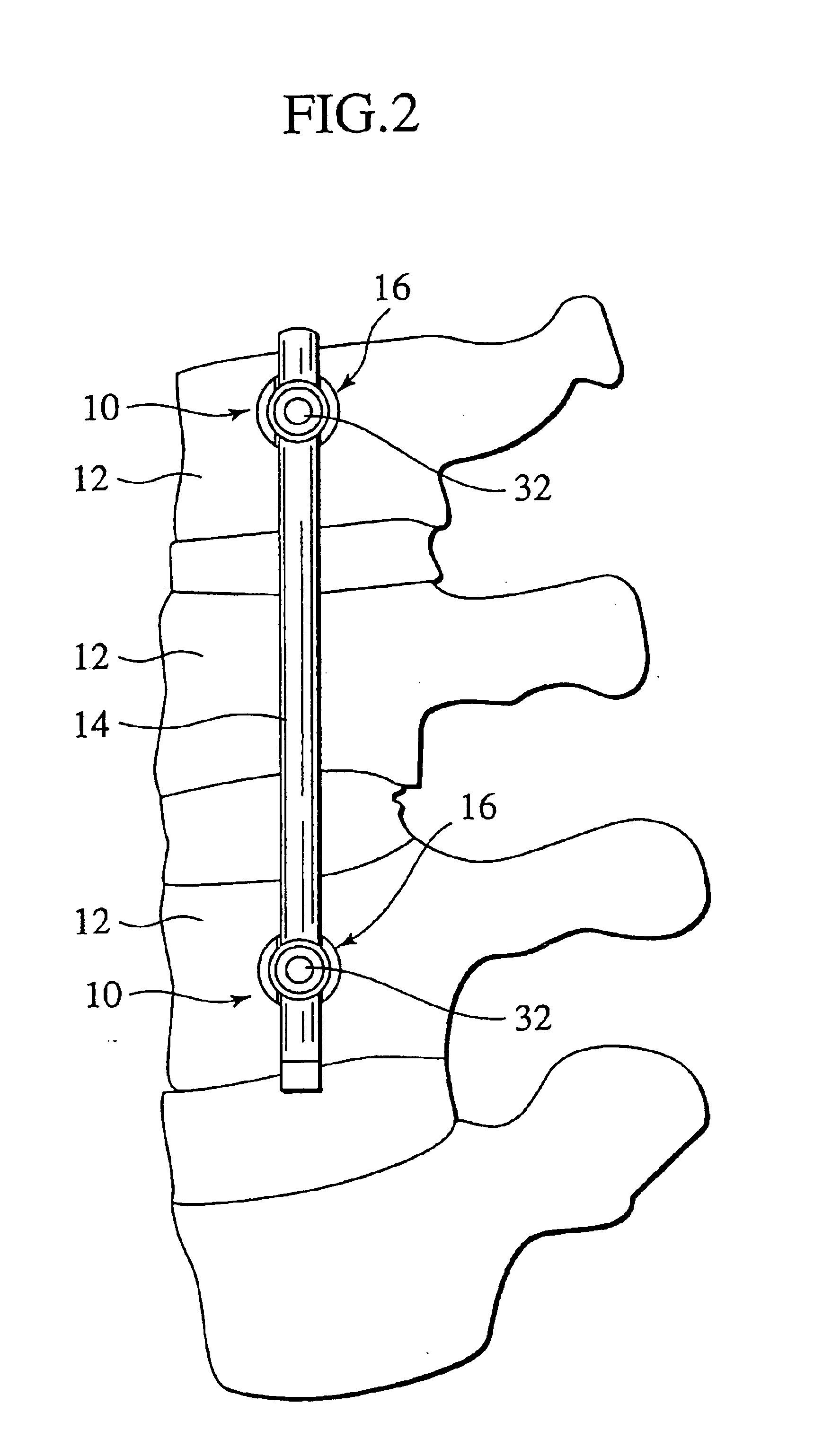 Spinal implant, driver tool and nut guide