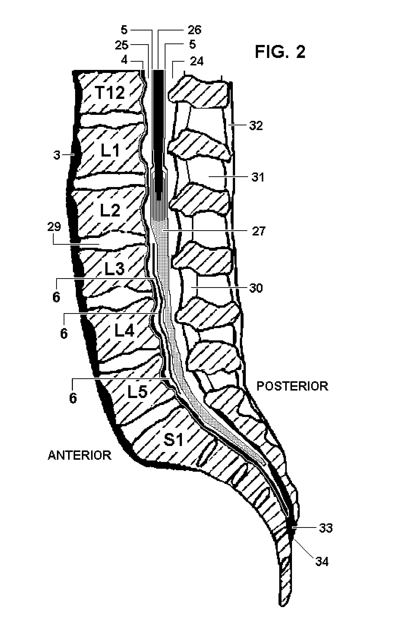 System and Methods for Diagnosis and Treatment of Discogenic Lower Back Pain