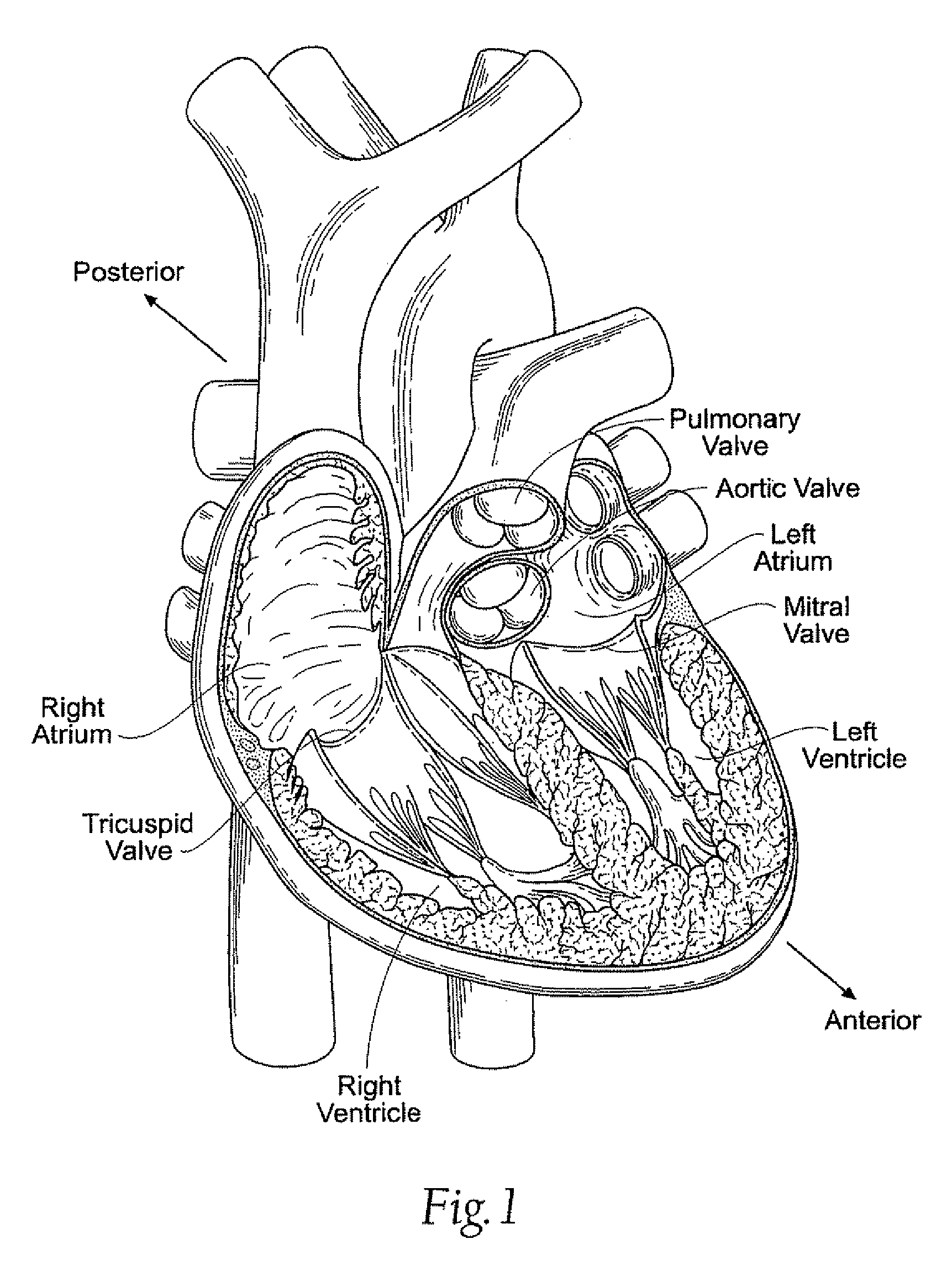 Inwardly-bowed tricuspid annuloplasty ring