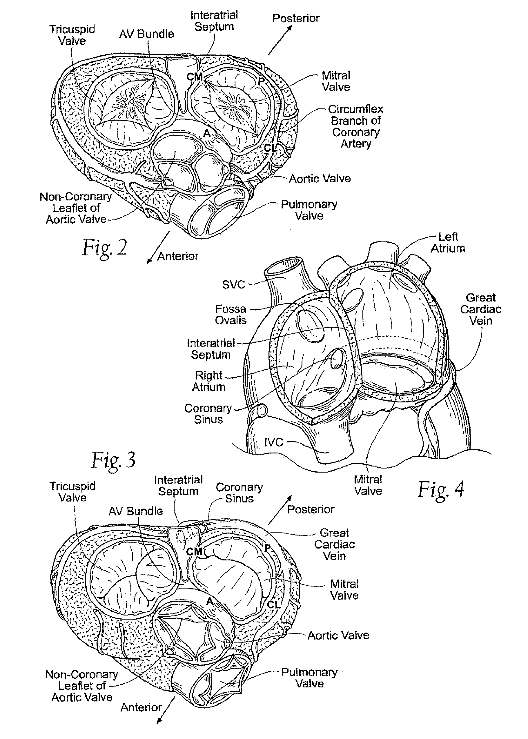 Inwardly-bowed tricuspid annuloplasty ring