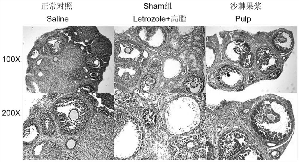 Application of sea buckthorn pulp in the prevention of polycystic ovary syndrome