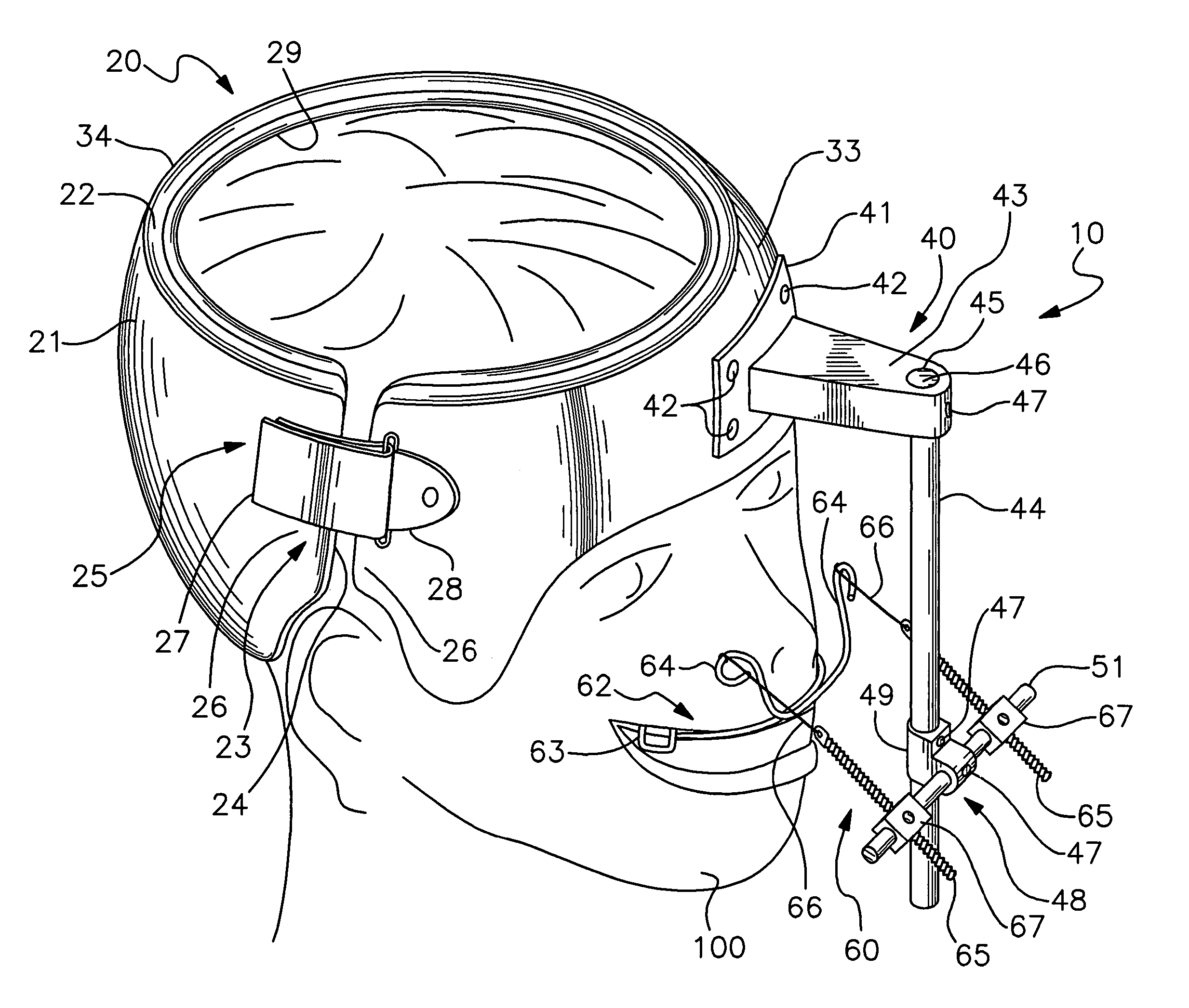 External fixation device for cranialmaxillofacial distraction