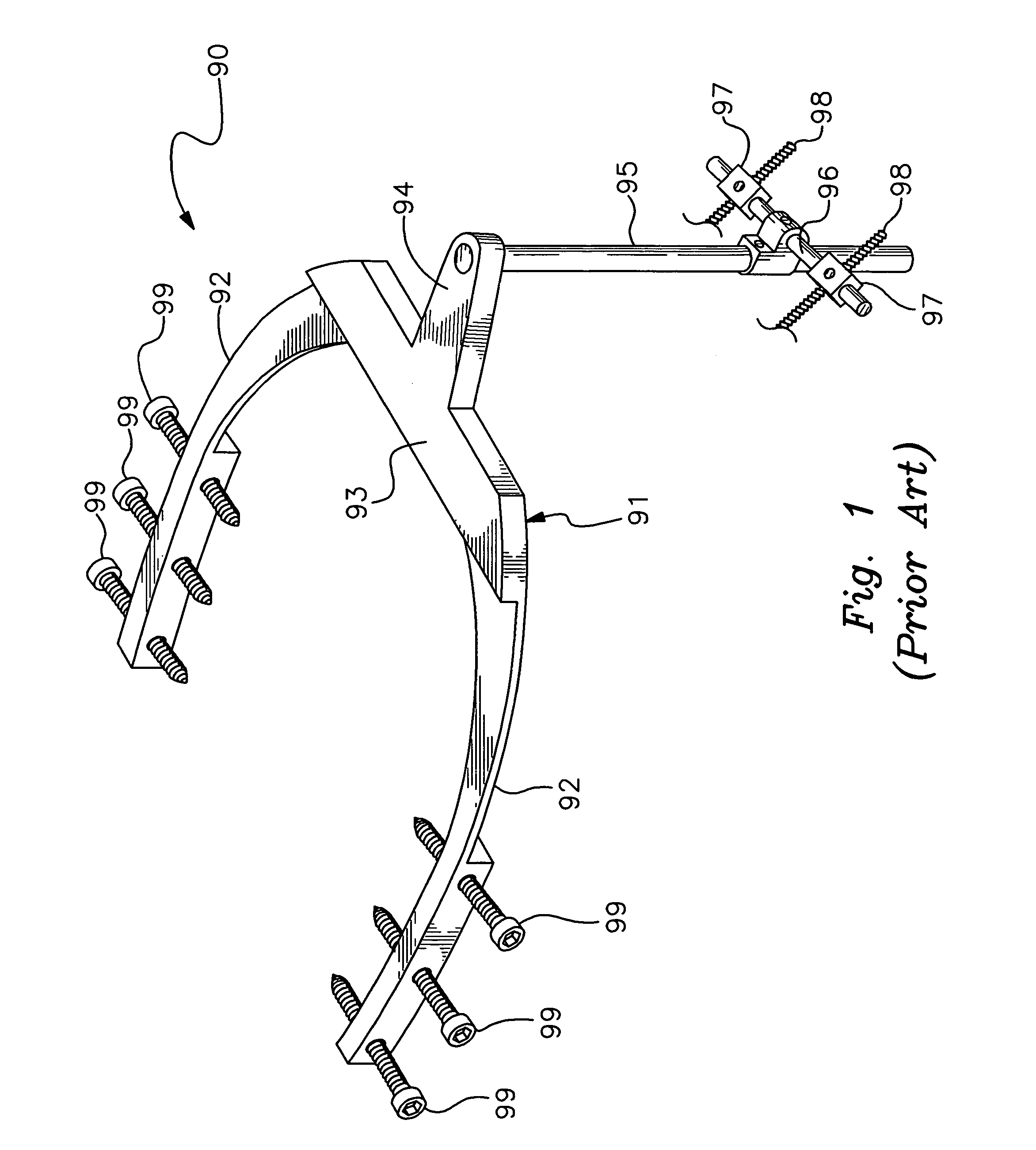 External fixation device for cranialmaxillofacial distraction